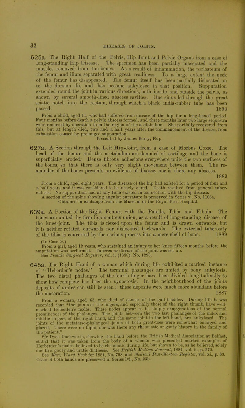 625a. The Riglit Half of tlie Pelvis, Hip Joint and Pelvic Organs from a case of long-standing Hip Disease. The specimen has been partially macerated and the muscles removed from the bones. As a result of inflammation, the periosteum of the femur and ilium separated with great readiness. To a large extent the neck of the femur has disappeared. The femur itself has been partially dislocated on to the dorsnm ilii, and has become ankylosed in that position. Suppuration extended round the joint in various directions, both inside and outside the pelvis, as shown by several smooth-lined abscess cavities. One sinus led through the great sciatic notch into the rectum, through which a black india-rubber tube has been passed. 1890 From a child, aged II, who had suffered from disease of the hip for a lengthened period. Four months before death a pelvic abscess formed, and three months later two large sequestra were removed by operation from the region of the acetabulum. She partially recovered from this, but at length died, two and a half years after the commencement of the disease, from exhaustion caused by prolonged suppuration. Presented by James Berry, Esq. 627a. A Section through the Left Hip-Joint, from a case of Morbus Coxae. The head of the femur and the acetabulum are denuded of cartilage and the bone is superficially eroded. Dense fibrous adhesions everywhere unite the two surfaces of the bones, so that there is only very slight movement between them. The re- mainder of the bones presents no evidence of disease, nor is there any abscess. 1889 From a child, aged eight years. The disease of the hip had existed for a period of four and a half years, and it was considered to be nearly cured. Death resulted from general tuber- culosis. No suppuration had at any time existed in connection with the hip-disease. A section of the spine showing angular curvature is preserved in Series v., No. II03a. Obtained in exchange from the Museum of the Koyal Free Hospital. 639a. A. Portion of the Right Femur, with the Patella, Tibia, and Fibula. The bones are united by firm ligamentous union, as a result of long-standing disease of the knee-joint. The tibia is flexed upon the femur and is drawn outwards, but it is neither rotated outwards nor dislocated backwards. The external tuberosity of the tibia is converted by the carious process into a mere shell of bone. 1889 (In Case Q.) From a girl, aged 12 years, who sustained an injury to her knee fifteen months before the amputation was performed. Tubercular disease of the joint was set up. See Female Surgical Bcgister, vol. i. (1888), No. 1298. 645a. The Right Hand of a woman which during life exhibited a marked instance of  Heberden's nodes. The terminal phalanges are united by bony ankylosis. The two distal phalanges of the fourth finger have been divided longitudinally to show how complete has been the synostosis. In the neighbourhood of the joints deposits of urates can still be seen ; these deposits were much more abundant before the maceration. 1887 From a woman, aged 63, who died of cancer of the gall-bladder. During life it was recorded that  the joints of the fingers, and especially those of the right thumb, have well- marked Heberden's nodes. These nodes appear to be simply exaggerations of the normal prominences of the phalanges. The joints between the two last phalanges of the index and middle fingers of the right hand, and the same joint in the left hand, are ankylosed. The joints of the mctatarso-phalangeal joints of both great-toes were somewhat enlarged and glazed. There were no tophi, nor was there any rheumatic or gouty history in the family of the patient. Sir Dyce Duckworth, showing the hand before the British Medical Association at Belfast, stated that it was taken from the body of a woman who presented marked examples of Herberdcn's nodes, believed to be rheumatic during life, but shown to be, as he believed, solely due to a gouty and uratic diathesis. See British Medical Journal., 1884, vol. ii., p. 270. See Mary Ward Book for 1884, No. 798, and Medical Post-Mort'sm Register, vol. xi., p. 88. Casts of both hands are preserved in Series Ivi., No. 23b.