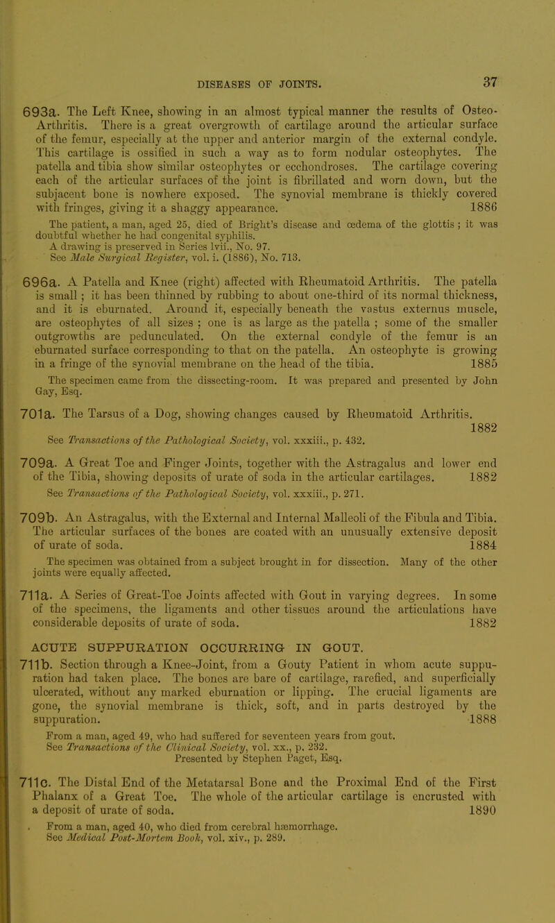 693a. The Left Knee, showing in an almost typical manner the results of Osteo- Arthritis. Tiicre is a great overgrowth of cartilage around the articular surface of the femur, especially at the upper and anterior margin of the external condyle. This cartilage is ossified in such a way as to form nodular osteophytes. The patella and tibia show similar osteophytes or ecchondroses. The cartilage covering each of the articular surfaces of the joint is fibrillated and worn down, but the subjacent bone is nowhere exposed. The synovial membrane is thickly covered with fringes, giving it a shaggy appearance. 1886 The patient, a man, aged 25, died of Briglit's disease and oedema of the glottis ; it was doubtful whether he had congenital syphilis. A drawing is preserved in Series Ivii., No. 97. See Male Surgical Begister, vol. i. (1886), No. 713. 696a. A Patella and Knee (right) affected with Rheumatoid Arthritis. The patella is small; it has been thinned by rubbing to about one-third of its normal thickness, and it is eburnated. Around it, especially beneath the vastus externus muscle, are osteophytes of all sizes : one is as large as the patella ; some of the smaller outgrowths are pedunculated. On the external condyle of the femur is an eburnated surface corresponding to that on the patella. An osteophyte is growing in a fringe of the synovial membrane on the head of the tibia. 1885 The specimen came from the dissecting-room. It was prepared and presented by John Gay, Esq. 701a. The Tarsus of a Dog, showing changes caused by Rheumatoid Arthritis. 1882 See Transactions of the Pathological Society, vol. xxxiii,, p. 432. 709a. A Great Toe and Finger Joints, together with the Astragalus and lower end of the Tibia, showing deposits of urate of soda in the articular cartilages. 1882 See Transactions of the Pathological Society, vol. xxxiii., p. 271. 709b. An Astragalus, with the External and Internal Malleoli of the Fibula and Tibia. The articular surfaces of the bones are coated with an unusually extensive deposit of urate of soda. 1884 The specimen was obtained from a subject brought in for dissection. Many of the other joints were equally aflEected. 711a. A Series of Great-Toe Joints affected with Gout in varying degrees. In some of the specimens, the ligaments and other tissues around the articulations have considerable deposits of urate of soda. 1882 ACUTE SUPPURATION OCCURRINa IN GOUT. 711b. Section through a Knee-Joint, from a Gouty Patient in whom acute suppu- ration had taken place. The bones are bare of cartilage, rarefied, and superficially ulcerated, without any marked eburnation or lipping. The crucial ligaments are gone, the synovial membrane is thick, soft, and in parts destroyed by the suppuration. 1888 From a man, aged 49, who had suffered for seventeen years from gout. See Transactions of the Clinical Society, vol. xx., p. 232. Presented by Stephen Paget, Esq. 711c. The Distal End of the Metatarsal Bone and the Proximal End of the First Phalanx of a Great Toe. The whole of the articular cartilage is encrusted with a deposit of urate of soda. 1890 From a man, aged 40, who died from cerebral hneraorrhage. See Medical Post-Mortem Booh, vol. xiv., p. 289.
