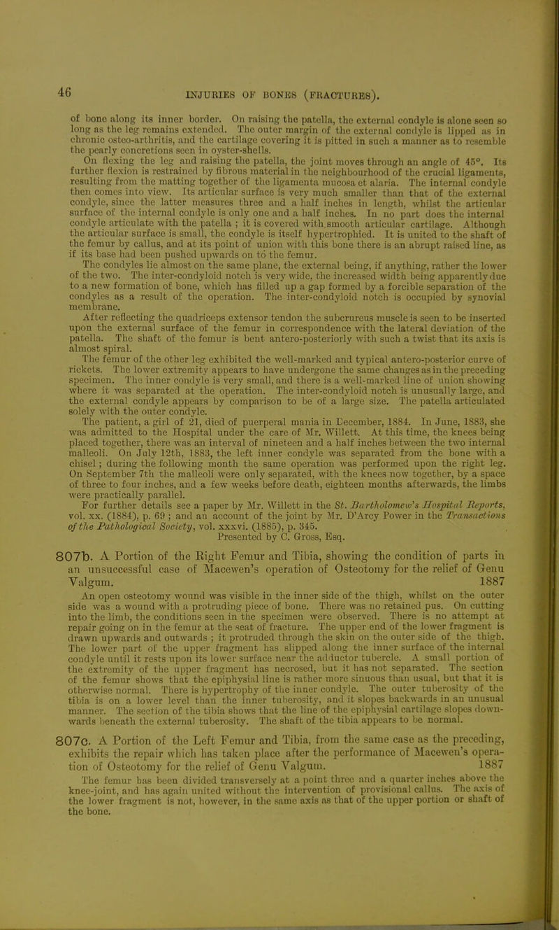 of bone along its inner border. On raising the patella, the external condyle is alone seen so long as the leg remains extended. The outer margin of the external condyle is lipped as in chmiiic ostco-arthritis, and the cartilage covering it is pitted in such a manner as to resemble the pearly concretions seen in oyster-shells. On flexing the leg and raising the patella, the joint moves througJi an angle of 45°. Its further flexion is restrained by fibrous material in the neighbourhood of the crucial ligaments, resulting from the matting together of the ligamenta mucosa et alaria. The internal condyle then comes into view. Its articular surface is very much smaller than that of the external condyle, since the latter measures three and a half inches in length, whilst the articular surface of the internal condyle is only one and a half inches. In no part does the internal condyle articulate with the patella ; it is covered with.smooth articular cartilage. Although the articular surface is small, the condyle is itself hypertrophied. It is united to the shaft of the femur by callus, and at its point of union with this bone there is an abrupt raised line, as if its base had been pushed upwards on to the femur. The condyles lie almost on the same plane, the external being, if anything, rather the lower of the two. The inter-condyloid notch is very wide, the increased width being apparently due to a new formation of bone, which has filled up a gap formed by a forcible separation of the condyles as a result of the operation. The inter-condyloid notch is occupied by synovial membrane. After reflecting the quadriceps extensor tendon the subcrureus muscle is seen to be inserted upon the external surface of the femur in correspondence with the lateral deviation of the patella. The shaft of the femur is bent antero-posteriorly with such a twist that its axis is almost spiral. The femur of the other leg exhibited the well-marked and typical antero-posterior curve of rickets. The lower extremity appears to have undergone the same changes as in the preceding specimen. The inner condyle is very small, and there is a well-marked line of union showing where it was separated at the operation. The inter-condyloid notch is unusually large, and the external condyle appears by comparison to be of a large size. The patella articulated solely with the outer condyle. The patient, a girl of 21, died of puerperal mania in December, 1884. In June, 1883, she was admitted to the Hospital under the care of Mr. Willett. At this time, the knees being placed together, there was an interval of nineteen and a half inches between the two internal malleoli. On July 12th, 1883, the left inner condyle was separated from the bone with a chisel; during the following month the same operation was performed upon the right leg. On September 7th the malleoli were only separated, with the knees now together, by a space of three to four inches, and a few weeks before death, eighteen months afterwards, the limbs were practically parallel. For further details see a paper by Mr. Willett in the St. Bartlioloinew's Hospital Reports, vol. XX. (1884), p. 69 ; and an account of the joint by Mr. D'Arcy Power in the Transactims of the Pathological Society, vol. xxxvi. (1885), p. 345. Presented by C. Gross, Esq. 807b. A Portion of the Eight Femur and Tibia, showing the condition of parts in an unsuccessful case of Macewen's operation of Osteotomy for the relief of Genu Valgum. 1887 An open osteotomy wound was visible in the inner side of the thigh, whilst on the outer side was a wound with a protruding piece of bone. There was no retained pus. On cutting into the limb, the conditions seen in the specimen were observed. There is no attempt at repair going on in the femur at the seat of fi-acture. The upper end of the lower fragment is drawn upwards and outwards ; it protruded through the skin on the outer side of the thigh. The lower part of the upper fragment has slipped along the inner surface of the internal condyle until it rests upon its lower surface near the adductor tubercle. A small portion of the extremity of the upper fragment has necrosed, but it has not separated. The section of the femur shows that the epiphysial line is rather more sinuous than usual, but that it is otherwise normal. There is hypertrophy of the inner condyle. The outer tuberosity of the tibia is on a lower level than the inner tuberosity, and it slopes backwards in an unusual manner. The section of the tibia shows that the line of the epiphysial cartilage slopes down- wards beneath the external tuberosity. The shaft of the tibia appears to be normal. 807c. A Portion of the Left Femur and Tibia, from the same case as the preceding, exhibits the repair wliich has taken place after the performance of Macewen's opera- tion of Osteotomy for the relief of Genu Valgum. 1887 The femur has been divided transversely at a point three and a quarter inches above the knee-joint, and has again united without the intervention of provisional callus. The .ixis of the lower fragment is not, however, in the same axis as that of the upper portion or shaft of the bone.