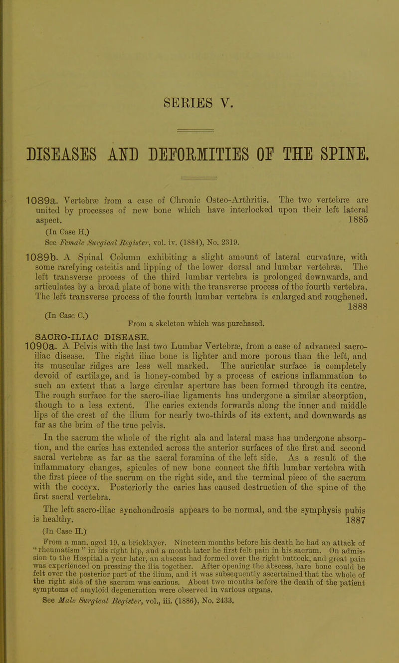 DISEASES Am DEEOEIITIES OP THE SPUE. 1089a. Vertebi-ffi from a case of Chronic Osteo-Arthritis. The two vertebr.ie are united by processes of new bone which have interlocked upon their left lateral aspect. 1885 (In Case H.) See Female Surgical Register, vol. iv. (1884), No. 2319. 1089b. A Spinal Column exhibiting a slight amount of lateral curvature, with some rarefying osteitis and lipping of the lower dorsal and lumbar vertebrse. The left transverse process of the third lumbar vertebra is prolonged downwards, and articulates by a broad plate of bone with the transverse process of the fourth vertebra. The left transverse process of the fourth lumbar vertebra is enlarged and roughened. 1888 (In Case C.) From a skeleton which was purchased. SACRO-ILIAC DISEASE. 1090a. A Pelvis with the last two Lumbar Vertebra, from a case of advanced sacro- ihac disease. The right iliac bone is lighter and more porous than the left, and its muscular ridges are less well marked. The auricular surface is completely devoid of cartilage, and is honey-combed by a process of carious inflammation to such an extent that a large circular aperture has been formed through its centre. The rough surface for the sacro-iliac ligaments has undergone a similar absorption, though to a less extent. The caries extends forwards along the inner and middle lips of the crest of the ilium for nearly two-thirds of its extent, and downwards as far as the brim of the true pelvis. In the sacrum the whole of the right ala and lateral mass has undergone absorp- tion, and the caries has extended across the anterior surfaces of the fii'st and second sacral vertebrse as far as the sacral foramina of the left side. As a result of the inflammatoiy changes, spicules of new bone connect the fifth lumbar vertebra with the first piece of the sacrum on the right side, and the terminal piece of the sacrum with the coccyx. Posteriorly the caries has caused destruction of the spine of the first sacral vertebra. The left sacro-iliac synchondrosis appears to be normal, and the symphysis pubis is healthy. 1887 (In Case H.) From a man, aged 19, a bricklayer. Nineteen months before his death he had an attack of  rheumatism  in his right hip, and a month later he first felt pain in his sacrum. On admis- sion to the Hospital a year later, an abscess had formed over the right buttock, and great pain was experienced on pressing the ilia together. After opening the abscess, bare bone could be felt over the posterior part of the ilium, and it was subsequently ascertained that the whole of the right side of the sacrum was carious. About two months before the death of the patient symptoms of amyloid degeneration were observed in various organs.