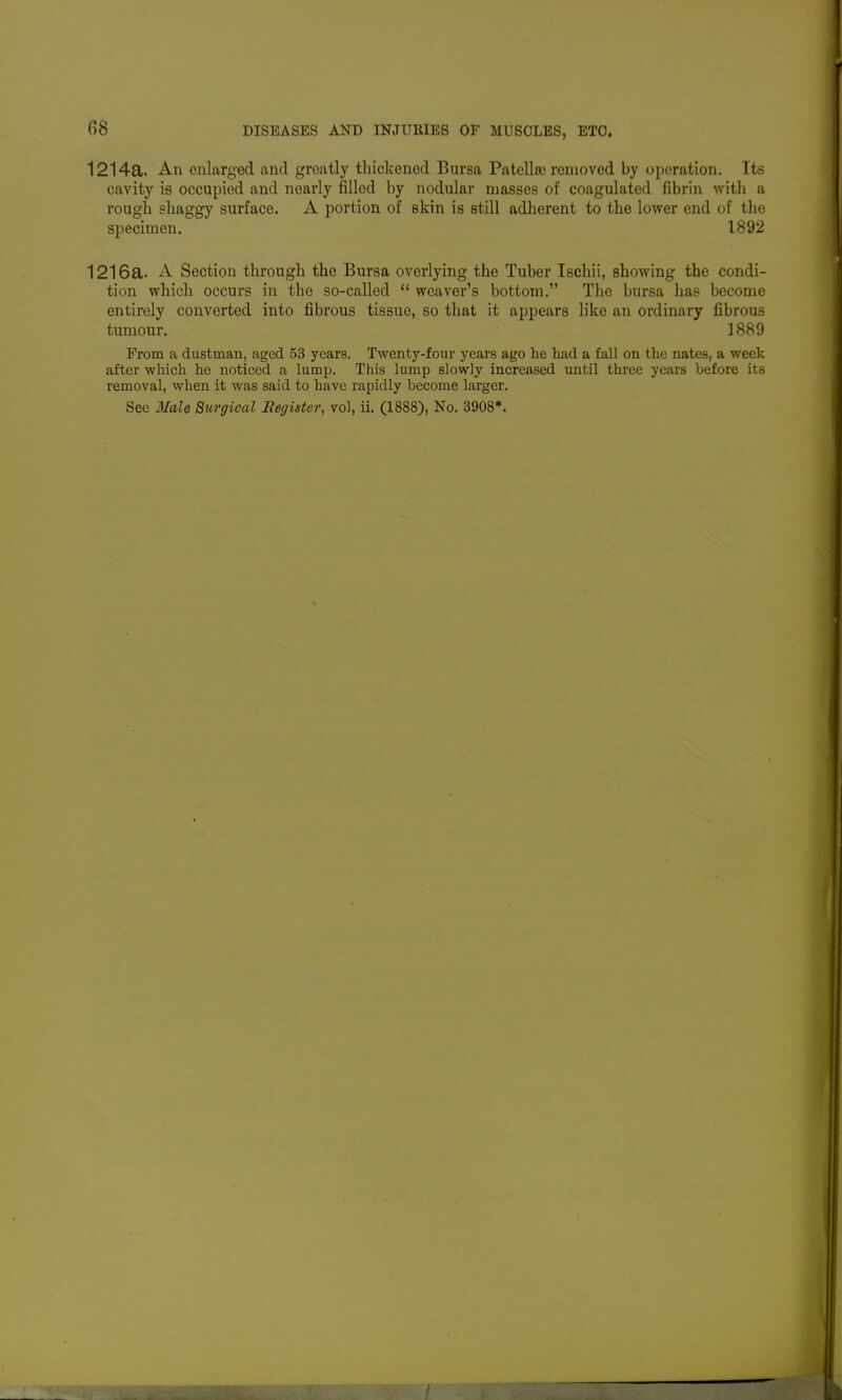 1214a. An enlarged and greatly thickened Bursa Patellse removed by operation. Its cavity is occupied and nearly filled by nodular masses of coagulated fibrin with a rough shaggy surface. A portion of skin is still adherent to the lower end of tlie specimen. 1892 1216a. A Section through the Bursa overlying the Tuber Ischii, showing the condi- tion which occurs in the so-called  weaver's bottom. The bursa has become entirely converted into fibrous tissue, so that it appears like an ordinary fibrous tumour. 1889 From a dustman, aged 53 years. Twenty-four years ago he had a fall on the nates, a week after which he noticed a lump. This lump slowly increased until three years before its removal, when it was said to have rapidly become larger.
