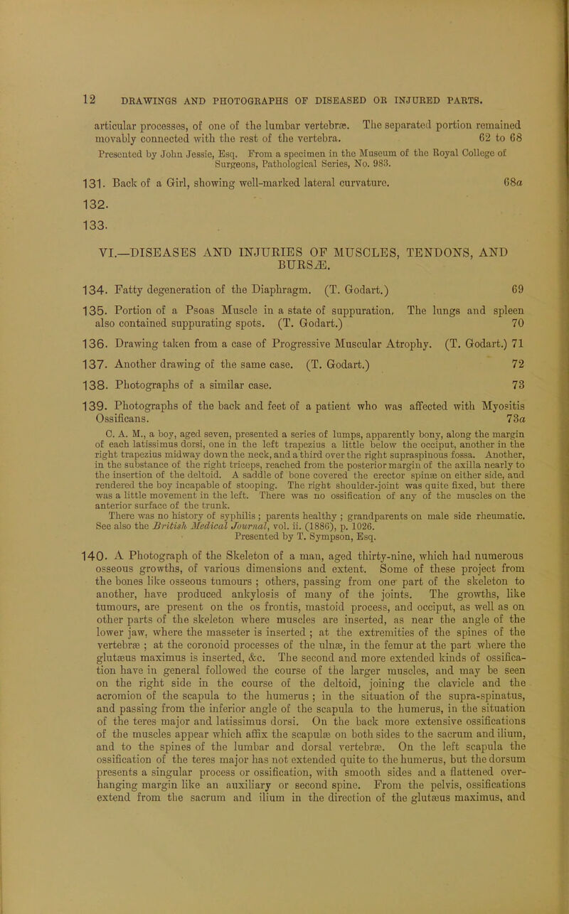 articular processes, of one of the lumbar vertebras. The separated portion remained movably connected with the rest of the vertebra. 62 to 68 Presented by John Jessie, Esq. From a specimen in the Museum of the Royal College of Surgeons, Pathological Series, No. 983. 131- Back of a Girl, showing well-marked lateral curvature. 68a 132. 133. VI.—DISEASES AND INJURIES OF MUSCLES, TENDONS, AND BURS.E. 134. Fatty degeneration of the Diaphragm. (T. Godart.) 69 135. Portion of a Psoas Muscle in a state of suppuration, The lungs and spleen also contained suppurating spots. (T. Godart.) 70 136. Drawing taken from a case of Progressive Muscular Atrophy. (T. Godart.) 71 137. Another drawing of the same case. (T. Godart.) 72 138. Photographs of a similar case. 73 139. Photographs of the back and feet of a patient who was affected with Myositis Ossificans. 73a C. A. M., a boy, aged seven, presented a series of lumps, apparently bony, along the margin of each latissimus dorsi, one in the left trapezius a little below the occiput, another in the right trapezius midway down the neck, and a third over the right supraspinous fossa. Another, in the substance of the right triceps, reached from the posterior margin of the axilla nearly to the insertion of the deltoid. A saddle of bone covered the erector spina? on either side, and rendered the boy incapable of stooping. The right shoulder-joint was quite fixed, but there was a little movement in the left. There was no ossification of any of the muscles on the anterior surface of the trunk. There was no history of syphilis ; parents healthy ; grandparents on male side rheumatic. See also the British Medical Journal, vol. ii. (1886), p. 1026. Presented by T. Sympson, Esq. 140. A Photograph of the Skeleton of a man, aged thirty-nine, which had numerous osseous growths, of various dimensions and extent. Some of these project from the bones like osseous tumours ; others, passing from one- part of the skeleton to another, have produced ankylosis of many of the joints. The growths, like tumours, are present on the os frontis, mastoid process, and occiput, as well as on other parts of the skeleton where muscles are inserted, as near the angle of the lower jaw, where the masseter is inserted ; at the extremities of the spines of the vertebrae ; at the coronoid processes of the ulnse, in the femur at the part where the glutaeus maximus is inserted, &c. The second and more extended kinds of ossifica- tion have in general followed the course of the larger muscles, and may be seen on the right side in the course of the deltoid, joining the clavicle and the acromion of the scapula to the humerus ; in the situation of the supra-spinatus, and passing from the inferior angle of the scapula to the humerus, in the situation of the teres major and latissimus dorsi. On the back more extensive ossifications of the muscles appear which affix the scapulas on both sides to the sacrum and ilium, and to the spines of the lumbar and dorsal vertebra?. On the left scapula the ossification of the teres major has not extended quite to the humerus, but the dorsum presents a singular process or ossification, with smooth sides and a flattened over- hanging margin like an auxiliary or second spine. From the pelvis, ossifications extend from the sacrum and ilium in the direction of the glutajus maximus, and