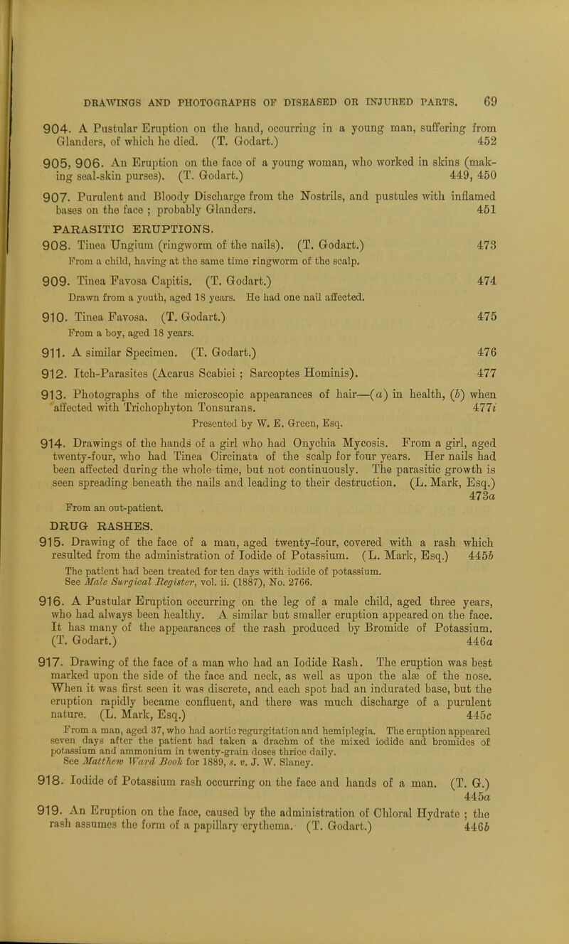 904. A Pustular Eruption on the band, occurring in a young man, suffering from Glanders, of which ho died. (T. Godart.) 452 905, 906. An Eruption on the face of a young woman, who worked in skins (mak- ing seal-skin purses). (T. Godart.) 449, 450 907. Purulent and Bloody Discharge from the Nostrils, and pustules with inflamed bases on the face ; probably Glanders. 451 PARASITIC ERUPTIONS. 908. Tinea Ungium (ringworm of the nails). (T. Godart.) 473 Prom a child, having at the same time ringworm of the scalp. 909. Tinea Favosa Capitis. (T. Godart.) 474 Drawn from a youth, aged 18 years. He had one nail affected. 910. Tinea Favosa. (T. Godart.) 475 From a boy, aged 18 years. 911. A similar Specimen. (T. Godart.) 476 912. Itch-Parasites (Acarus Scabiei ; Sarcoptes Hominis). 477 913. Photographs of the microscopic appearances of hair—(a) in health, (b) when affected with Trichophyton Tonsurans. 477e Presented by W. E. Green, Esq. 914- Drawings of the hands of a girl who had Onychia Mycosis. From a girl, aged twenty-four, who had Tinea Oircinata of the scalp for four years. Her nails had been affected during the whole time, but not continuously. The parasitic growth is seen spreading beneath the nails and leading to their destruction. (L. Mark, Esq.) 473a From an out-patient. DRUG RASHES. 915. Drawing of the face of a man, aged twenty-four, covered with a rash which resulted from the administration of Iodide of Potassium. (L. Mark, Esq.) 4455 The patient had been treated for ten days with iodide of potassium. See Male Surgical Register, vol. ii. (1887), No. 2766. 916. A Pustular Eruption occurring on the leg of a male child, aged three years, who had always been healthy. A similar but smaller eruption appeared on the face. It has many of the appearances of the rash produced by Bromide of Potassium. (T. Godart.) 446a 917. Drawing of the face of a man who had an Iodide Rash. The eruption was best marked upon the side of the face and neck, as well as upon the ala3 of the nose. When it was first seen it was discrete, and each spot had an indurated base, but the eruption rapidly became confluent, and there was much discharge of a purulent nature. (L. Mark, Esq.) 445c From a man, aged 37, who had aortic regurgitation and hemiplegia. The eruption appeared seven days after the patient had taken a drachm of the mixed iodide and bromides of potassium and ammonium in twenty-grain doses thrice daily. See Matthew Ward Booh for 1889, s. v. J. W. Slaney. 918. Iodide of Potassium rash occurring on the face and hands of a man. (T. G.) 445a 919. An Eruption on the face, caused by the administration of Chloral Hydrate ; the rash assumes the form of a papillary erythema. (T. Godart.) 4466