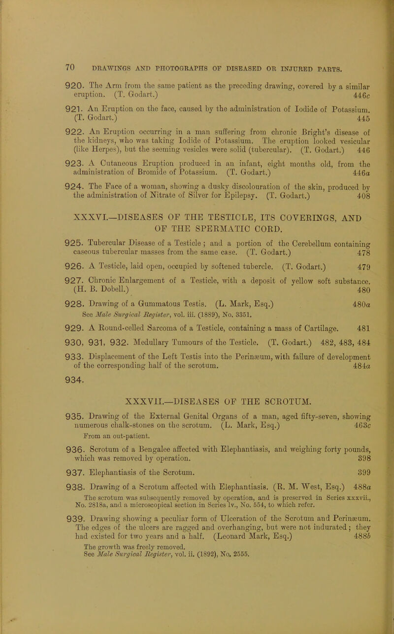 920. The Ann from the same patient as the preceding drawing, covered by a similar eruption. (T. Godart.) 446c 921- An Eruption on the face, caused by the administration of Iodide of Potassium. (T. Godart.) 445 922. An Eruption occurring in a man suffering from chronic Bright's disease of the kidneys, who was taking Iodide of Potassium. The eruption looked vesicular (like Herpes), but the seeming vesicles were solid (tubercular). (T. Godart.) 446 923. A Cutaneous Eruption produced in an infant, eight months old, from the administration of Bromide of Potassium. (T. Godart.) 446a 924. The Face of a woman, showing a dusky discolouration of the skin, produced by the administration of Nitrate of Silver for Epilepsy. (T. Godart.) 408 XXXVI.—DISEASES OP THE TESTICLE, ITS COVERINGS, AND OF THE SPERMATIC CORD. 925. Tubercular Disease of a Testicle ; and a portion of the Cerebellum containing caseous tubercular masses from the same case. (T. Godart.) 478 926- A Testicle, laid open, occupied by softened tubercle. (T. Godart.) 479 927. Chronic Enlargement of a Testicle, with a deposit of yellow soft substance. (H. B. Dobell.) 480 928. Drawing of a Gummatous Testis. (L. Mark, Esq.) 480a See Male Surgical Register, vol. iii. (1889), No. 3351. 929. A Round-celled Sarcoma of a Testicle, containing a mass of Cartilage. 481 930. 931, 932. Medullary Tumours of the Testicle. (T. Godart.) 482, 483, 484 933. Displacement of the Left Testis into the Perineum, with failure of development of the corresponding half of the scrotum. 484a 934. XXXV1L—DISEASES OF THE SCROTUM. 935. Drawing of the External Genital Organs of a man, aged fifty-seven, showing numerous chalk-stones on the scrotum. (L. Mark, Esq.) 463c From an out-patient. 936. Scrotum of a Bengalee affected with Elephantiasis, and weighing forty pounds, which was removed by operation. 398 937. Elephantiasis of the Scrotum. 399 938. Drawing of a Scrotum affected with Elephantiasis. (R. M. West, Esq.) 4S8a The scrotum was subsequently removed by operation, and is preserved in Series xxxvii., No. 2818a, and a microscopical section in Series lv., No. 554, to which, refer. 939. Drawing showing a peculiar form of Ulceration of the Scrotum and Perineum. The edges of the ulcers are ragged and overhanging, but were not indurated; they had existed for two years and a half. (Leonard Mark, Esq.) 488£ The growth was freely removed. See Male Surgical Register, vol. ii. (1892), No. 2555.