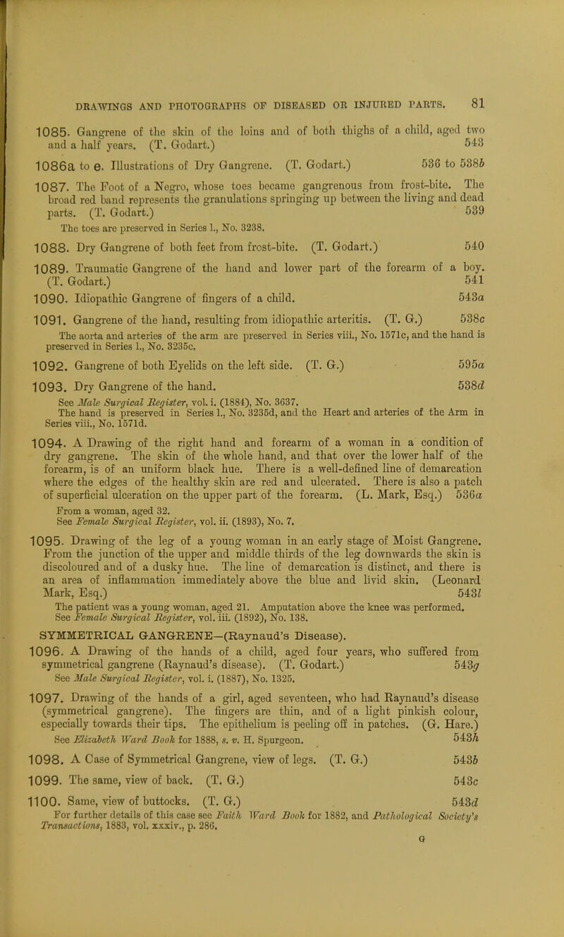 1085. Gangrene of the skin of the loins and of both thighs of a child, aged two and a half years. (T. Godart.) 543 1086a to e. Illustrations of Dry Gangrene. (T. Godart.) 536 to 5386 1087. Tho Foot of a Negro, whoso toes became gangrenous from frost-bite. The broad red band represents the granulations springing up between the living and dead parts. (T. Godart.) 539 The toes are preserved in Series 1., No. 3238. 1088. Dry Gangrene of both feet from frost-bite. (T. Godart.) 540 1089. Traumatic Gangrene of the hand and lower part of the forearm of a boy. (T. Godart.) 541 1090. Idiopathic Gangrene of fingers of a child. 543a 1091. Gangrene of the hand, resulting from idiopathic arteritis. (T. G.) 538c The aorta and arteries of the arm are preserved in Series viii., No. 1571c, and the hand is preserved in Series 1., No. 3235c. 1092. Gangrene of both Eyelids on the left side. (T. G.) 595a 1093. Dry Gangrene of the hand. 538a' See Male Surgical Register, vol* i. (1884), No. 3637. The hand is preserved in Series 1., No. 3235d, and the Heart and arteries of the Arm in Series viii., No. 1571d. 1094. A Drawing of the right hand and forearm of a woman in a condition of dry gangrene. The skin of the whole hand, and that over the lower half of the forearm, is of an uniform black hue. There is a well-defined line of demarcation where the edges of the healthy skin are red and ulcerated. There is also a patch of superficial ulceration on the upper part of the forearm. (L. Mark, Esq.) 536a From a woman, aged 32. See Female Surgical Register, vol. ii. (1893), No. 7. 1095. Drawing of the leg of a young woman in an early stage of Moist Gangrene. From the junction of the upper and middle thirds of the leg downwards the skin is discoloured and of a dusky hue. The line of demarcation is distinct, and there is an area of inflammation immediately above the blue and livid skin. (Leonard Mark, Esq.) 543Z The patient was a young woman, aged 21. Amputation above the knee was performed. See Female Surgical Register, vol. iii. (1892), No. 138. SYMMETRICAL GANGRENE—(Raynaud's Disease). 1096. A Drawing oE the hands of a child, aged four years, who suffered from symmetrical gangrene (Eaynaud's disease). (T. Godart.) 543^r See Male Surgical Register, vol. i. (1887), No. 1325. 1097. Drawing of the hands of a girl, aged seventeen, who had Raynaud's disease (symmetrical gangrene). The fingers are thin, and of a light pinkish colour, especially towards their tips. The epithelium is peeling off in patches. (G. Hare.) See Elizabeth Ward Book for 1888, s. v. H. Spurgeon. 543A 1098. A Case of Symmetrical Gangrene, view of legs. (T. G.) 5436 1099. The same, view of back. (T. G.) 543c 1100. Same, view of buttocks. (T. G.) 543c? For further details of this case see Faith Ward Booh for 1882, and Pathological Society's Transactions, 1883, vol. xxxiv., p. 286. G