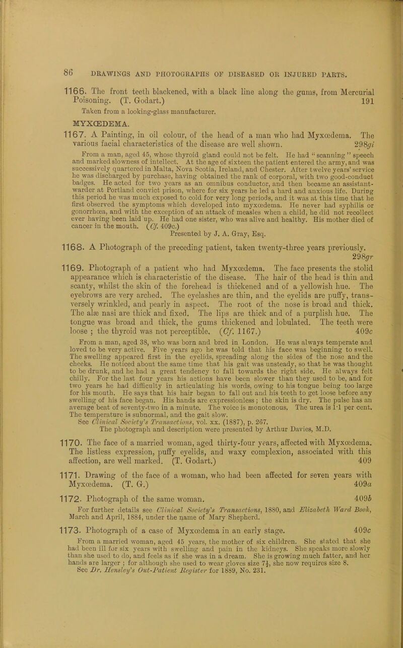 1166. The front teeth blackened, with a black line along the gums, from Mercurial Poisoning. (T. Godart.) 191 Taken from a looking-glass manufacturer. MYXCEDEMA. 1167. A Painting, in oil colour, of the head of a man who had Myxcedema. The various facial characteristics of the disease are well shown. 2$8gi From a man. aged 45, whose thyroid gland could not be felt. He had  scanning  speech and marked slowness of intellect. At the age of sixteen the patient entered the army, and was successively quartered in Malta, Nova Scotia, Ireland, and Chester. After twelve years' service he was discharged by purchase, having obtained the rank of corporal, with two good-conduct badges. He acted for two years as an omnibus conductor, and then became an assistant- warder at Portland convict prison, where for six years he led a hard and anxious life. DuriDg this period he was much exposed to cold for very long periods, and it was at this time that he first observed the symptoms which developed into myxcedema. He never had syphilis or gonorrhoea, and with the exception of an attack of measles when a child, he did not recollect ever having been laid up. He had one sister, who was alive and healthy. His mother died of cancer in the mouth. (Cf. 409c.) Presented by J. A. Gray, Esq. 1168. A Photograph of the preceding patient, taken twenty-three years previously. 298<7r 1169. Photograph of a patient who had Myxcedema. The face presents the stolid appearance which is characteristic of the disease. The hair of the head is thin and scanty, whilst the skin of the forehead is thickened and of a yellowish hue. The eyebrows are very arched. The eyelashes are thin, and the eyelids are puffy, trans- versely wrinkled, and pearly in aspect. The root of the nose is broad and thick. The alas nasi are thick and fixed. The lips are thick and of a purplish hue. The tongue was broad and thick, the gums thickened and lobulated. The teeth were loose ; the thyroid was not perceptible, (Cf. 1167.) 409c From a man, aged 38, who was born and bred in London. He was always temperate and loved to be very active. Five years ago he was told that his face was beginning to swell. The swelling appeared first in the eyelids, spreading along the sides of the nose and the cheeks. He noticed about the same time that his gait was unsteady, so that he was thought to be drunk, and he had a great tendency to fall towards the right side. He always felt chilly. For the last four years his actions have been slower than they used to be, and for two years he had difficulty in articulating his words, owing to his tongue being too large for his mouth. He says that his hair began to fall out and his teeth to get loose before any swelling of his face began. His hands are expressionless ; the skin is dry. The pulse has an average beat of seventy-two in a minute. The voice is monotonous. The urea is PI per cent. The temperature is subnormal, and the gait slow. See Clinical Society's Transactions, vol. xx. (1887), p. 267. The photograph and description were presented by Arthur Davies, M.D. 1170. The face of a married woman, aged thirty-four years, affected with Myxcedema. The listless expression, puffy eyelids, and waxy complexion, associated with this affection, are well marked. (T. Godart.) 409 1171. Drawing of the face of a woman, who had been affected for seven years with Myxcedema. (T. G.) 409a 1172. Photograph of the same woman. 409i For further details see Clinical Society's Transactions, 1880, and Elizabeth Ward Book, March and April, 1884. under the name of Mary Shepherd. 1173. Photograph of a case of Myxcedema in an early stage. 409c From a married woman, aged 45 years, the mother of six children. She stated that she had been ill for six years with swelling and pain in the kidneys. She speaks more slowly than she used to do, and feels as if she was in a dream. She is growing much fatter, and her hands are larger ; for although she used to wear gloves size 7$, she now requires size 8. See Br. Hensley's Out-Patient Register for 1889, No. 231.