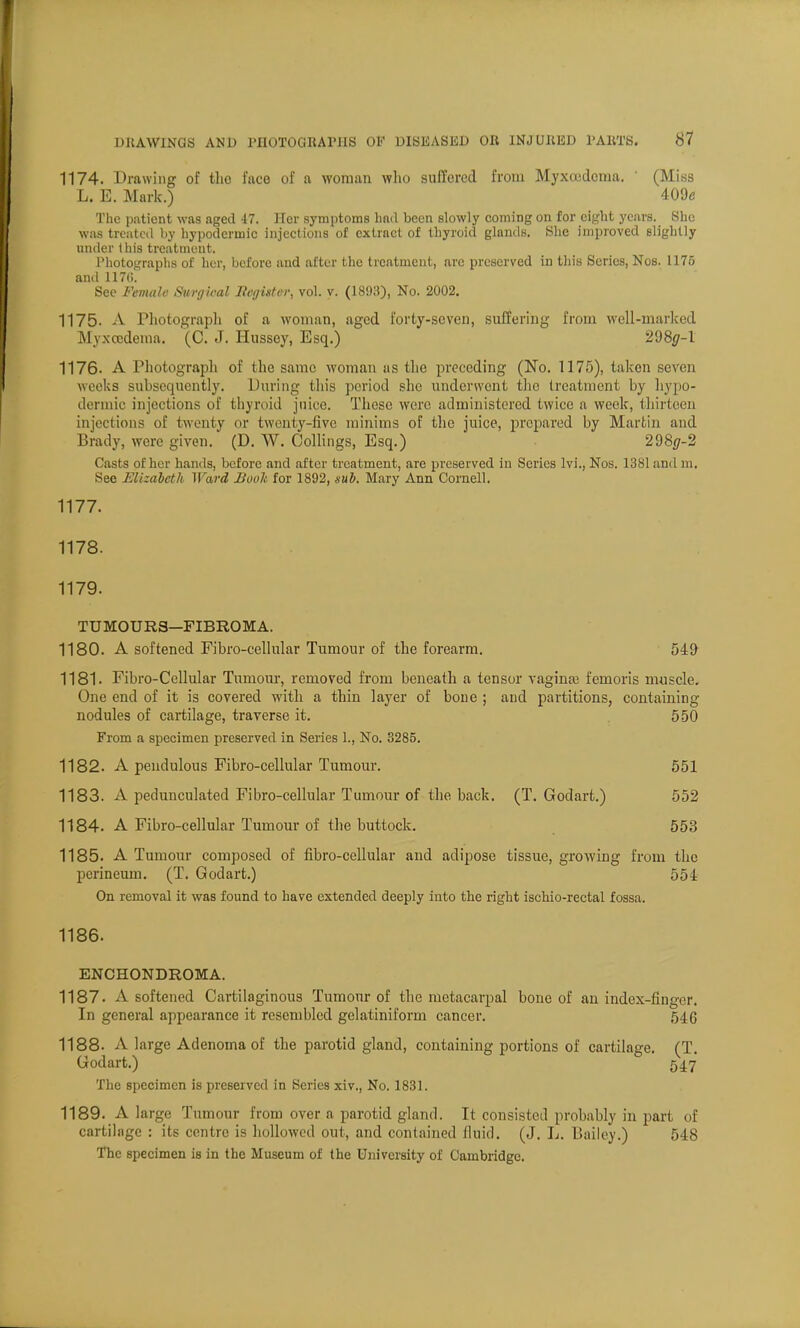 1174. Drawing of the face of a woman who suffered from Myxcedcma. ' (Miss L. E. Mark.) 409* The patient was aged 47. Her symptoms had been slowly coming on for eight years. She was treated by hypodermic injections of extract of thyroid glands. She improved slightly under this treatment. Photographs of her, before and after the treatment, are preserved in this Series, Nos. 1175 and 1170. See Female Surgical Register, vol. v. (1893), No. 2002. 1175. A Photograph of a woman, aged forty-seven, suffering from well-marked Myxcedema. (C. J. Hussoy, Esq.) 298<7-l 1176- A Photograph of the same woman as the preceding (No. 1175), taken seven weeks subsequently. During this period she underwent the treatment by hypo- dermic injections of thyroid juice. These were administered twice a week, thirteen injections of twenty or twenty-five minims of the juice, prepared by Martin and Brady, were given. (D. W. Collings, Esq.) 298(7-2 Casts of her hands, before and after treatment, are preserved in Scries lvi., Nos. 1381 and m. See Elizabeth Wwi Book for 1892, sub. Mary Ann Cornell. 1177. 1178. 1179. TUMOURS—FIBROMA. 1180. A softened Fibro-cellular Tumour of the forearm. 549 1181. Fibro-Cellular Tumour, removed from beneath a tensor vagina; femoris muscle. One end of it is covered with a thin layer of bone ; and partitions, containing nodules of cartilage, traverse it. 550 From a specimen preserved in Series 1., No. 3285. 1182. A pendulous Fibro-cellular Tumour. 551 1183. A pedunculated Fibro-cellular Tumour of the back. (T. Godart.) 552 1184. A Fibro-cellular Tumour of the buttock. 553 1185. A Tumour composed of fibro-cellular and adipose tissue, growing from the perineum. (T. Godart.) 554 On removal it was found to have extended deeply into the right ischio-rectal fossa. 1186. ENCHONDROMA. 1187. A softened Cartilaginous Tumour of the metacarpal bone of an index-finger. In general appearance it resembled gelatiniform cancer. 546 1188. A large Adenoma of the parotid gland, containing portions of cartilage. (T. Godart.) 547 The specimen is preserved in Series xiv., No. 1831. 1189. A large Tumour from over a parotid gland. It consisted probably in part of cartilage : its centre is hollowed out, and contained fluid. (J. L. Bailey.) 548 The specimen is in the Museum of the University of Cambridge.