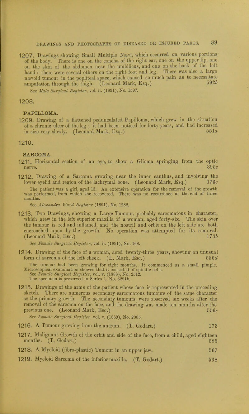 1207. Drawings showing Small Multiple N;uvi, which occurred on various portions of the body. There is ono on the concha of the right ear, one on the upper lip, one on the skin of the abdomen near the umbilicus, and one on the back of the left hand ; there were several others on tho right foot and leg. There was also a large rwevoid tumour in the popliteal space, which caused so much pain as to necessitate amputation through the thigh. (Leonard Mark, Esq.) 5926 See Male Surgical Register, vol. ii. (1891), No. 1597. 1208. PAPILLOMA. 1209. Drawing of a llattcncd pedunculated Papilloma, which grew in the situation of a chronic ulcer of the leg ; it had been noticed for forty years, and had increased in size very slowly. (Leonard Mark, Esq.) 551a 1210. SARCOMA. 1211. Horizontal section of an eye, to show a Glioma springing from the optic nerve. 395c 1212. Drawing of a Sarcoma growing near the inner canthus, and involving the lower eyelid and region of the lachrymal bone. (Leonard Mark, Esq.) 173c The patient was a girl, aged 13. An extensive operation for the removal of the growth was performed, from which she recovered. There was no recurrence at the end of three months. See Alexandra Ward Register (1891), No. 1282. 1213. Two Drawings, showing a Large Tumour, probably sarcomatous in character, which grew in the left superior maxilla of a woman, aged forty-six. The skin over the tumour is red and inflamed, and the nostril and orbit on the left side are both encroached upon by the growth. No operation was attempted for its removal. (Leonard Mark, Esq.) 173J See Female Surgical Register, vol. ii. (1891), No. 168. 1214. Drawing of the face of a woman, aged twenty-three years, showing an unusual form of sarcoma of the left cheek. (L. Mark, Esq.) 556c/ The tumour had been growing for eight months. It commenced as a small pimple. Microscopical examination showed that it consisted of spindle cells. See Female Surgical Register, vol. v. (1888), No. 2512. The specimen is preserved in Series 1., No. 3294 b. 1215. Drawings of the arms of the patient whose face is represented in the preceding sketch. There are numerous secondary sarcomatous tumours of the same character as the primary growth. The secondary tumours were observed six weeks after the removal of the sarcoma on the face, and the drawing was made ten months after the previous one. (Leonard Mark, Esq.) 556c See Female Surgical Register, vol. v. (1889), No. 2005. 1216. A Tumour growing from the antrum. (T. Godart.) 173 1217. Malignant Growth of the orbit and side of the face, from a child, aged eighteen months. (T. Godart.) 585 1218. A Myeloid (fibro-plastic) Tumour in an upper jaw. 567 1219. Myeloid Sarcoma of the inferior maxilla. (T. Godart.) 568