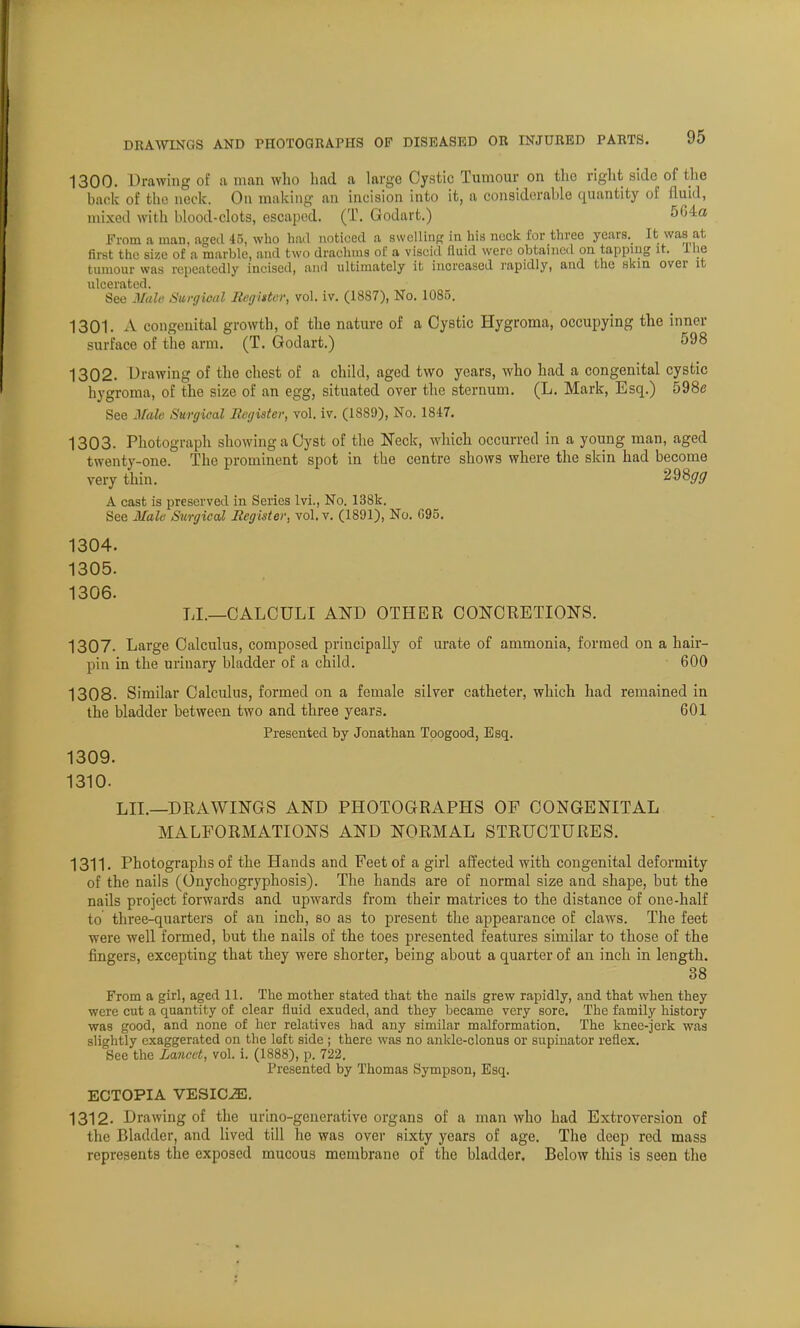 1300. Drawing of a man who had a large Cystic Tumour on the right side of the back of the neck. On making an incision into it, a considerable quantity of fluid, mixed with blood-clots, escaped. (T. Godart.) 564a From a man, aged 45, who had noticed a swelling in his neck for three years. It was at first the size of a marble, and two drachms of a viscid fluid were obtained on tapping it. 1 lie tumour was repeatedly incised, and ultimately it increased rapidly, and the skin over it ulcerated. See Male Surgical Register, vol. iv. (1887), No. 1085. 1301. A congenital growth, of the nature of a Cystic Hygroma, occupying the inner surface of the arm. (T. Godart.) 598 1302. Drawing of the chest of a child, aged two years, who had a congenital cystic hygroma, of the size of an egg, situated over the sternum. (L. Mark, Esq.) 598e See Male. Surgical Register, vol. iv. (1889), No. 1847. 1303. Photograph showing a Cyst of the Neck, which occurred in a young man, aged twenty-one. The prominent spot in the centre shows where the skin had become very thin. 298<7^ A cast is preserved in Series lvi., No. 138k. See Male Surgical Register, vol. v. (1801), No. G95. 1304. 1305. 1306. LL—CALCULI AND OTHER CONCRETIONS. 1307. Large Calculus, composed principally of urate of ammonia, formed on a hair- pin in the urinary bladder of a child. 600 1308. Similar Calculus, formed on a female silver catheter, which had remained in the bladder between two and three years. 601 Presented by Jonathan Toogood, Esq. 1309. 1310. LIL—DRAWINGS AND PHOTOGRAPHS OF CONGENITAL MALFORMATIONS AND NORMAL STRUCTURES. 1311. Photographs of the Hands and Feet of a girl affected with congenital deformity of the nails (Onychogryphosis). The hands are of normal size and shape, but the nails project forwards and upwards from their matrices to the distance of one-half to three-quarters of an inch, so as to present the appearance of claws. The feet were well formed, but the nails of the toes presented features similar to those of the fingers, excepting that they were shorter, being about a quarter of an inch in length. 38 From a girl, aged 11. The mother stated that the nails grew rapidly, and that when they were cut a quantity of clear fluid exuded, and they became very sore. The family history was good, and none of her relatives had any similar malformation. The knee-jerk was slightly exaggerated on the loft side ; there was no ankle-clonus or supinator reflex. See the Lancet, vol. i. (1888), p. 722. Presented by Thomas Sympson, Esq. ECTOPIA VESICJE. 1312. Drawing of the urino-generative organs of a man who had Extroversion of the Bladder, and lived till he was over Bixty years of age. The deep red mass represents the exposed mucous membrane of the bladder. Below this is seen the
