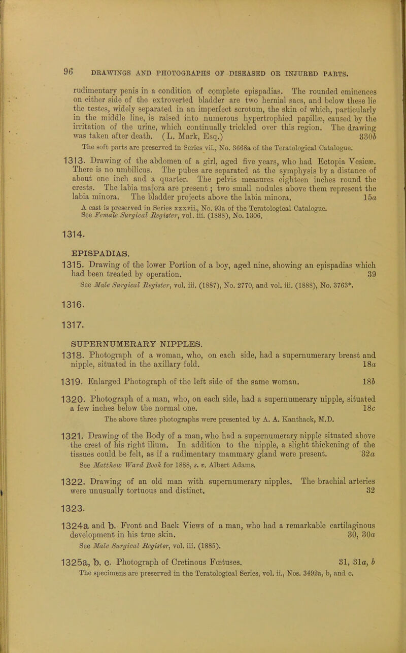 rudimentary penis in a condition of complete epispadias. The rounded eminences on either side of the extroverted bladder are two hernial sacs, and below these lie tho testes, widely separated in an imperfect scrotum, the skin of which, particularly in the middle line, is raised into numerous hypertrophied papilla1, caused by the irritation of the urine, which continually trickled over this region. Tbe drawing was taken after death. (L. Mark, Esq.) 3306 The soft parts are preserved in Scries vii., No. 3G68a of the Teratological Catalogue. 1313. Drawing of the abdomen of a girl, aged five years, who had Ectopia Vesica?. There is no umbilicus. The pubes are separated at the symphysis by a distance of about one inch and a quarter. The pelvis measures eighteen inches round the crests. The labia majora are present; two small nodules above them represent the labia minora. The bladder projects above the labia minora. 15a A cast is preserved in Series xxxvii., No. 93a of the Teratological Catalogue. See Female Surgical Register, vol. iii. (1888), No. 1306. 1314. EPISPADIAS. 1315. Drawing of the lower Portion of a boy, aged nine, showing an epispadias which had been treated by operation. 39 See Male Surgical Register, vol. iii. (1887), No. 2770, and vol. iii. (1888), No. 3763*. 1316. 1317. SUPERNUMERARY NIPPLES. 1318. Photograph of a woman, who, on each side, had a supernumerary breast and nipple, situated in the axillary fold. 18a 1319. Enlarged Photograph of the left side of the same woman. 185 1320. Photograph of a man, who, on each side, had a supernumerary nipple, situated a few inches below the normal one. 18c The above three photographs were presented by A. A. Kanthack, M.D. 1321. Drawing of the Body of a man, who had a supernumerary nipple situated above the crest of his right ilium. In addition to the nipple, a slight thickening of the tissues could be felt, as if a rudimentary mammary gland were present. 32a See Matthew Ward Booh for 1888, s. v. Albert Adams. 1322. Drawing of an old man with supernumerary nipples. The brachial arteries were unusually tortuous and distinct. 32 1323. 1324a and b. Front and Back Views of a man, who had a remarkable cartilaginous development in his true skin. 30, 30a See Male Surgical Register, vol. iii. (1885). 1325a, b, C Photograph of Cretinous Foetuses. 31, 31a, b The specimens are preserved in the Teratological Series, vol. ii., Nos. 3492a, b, and c.