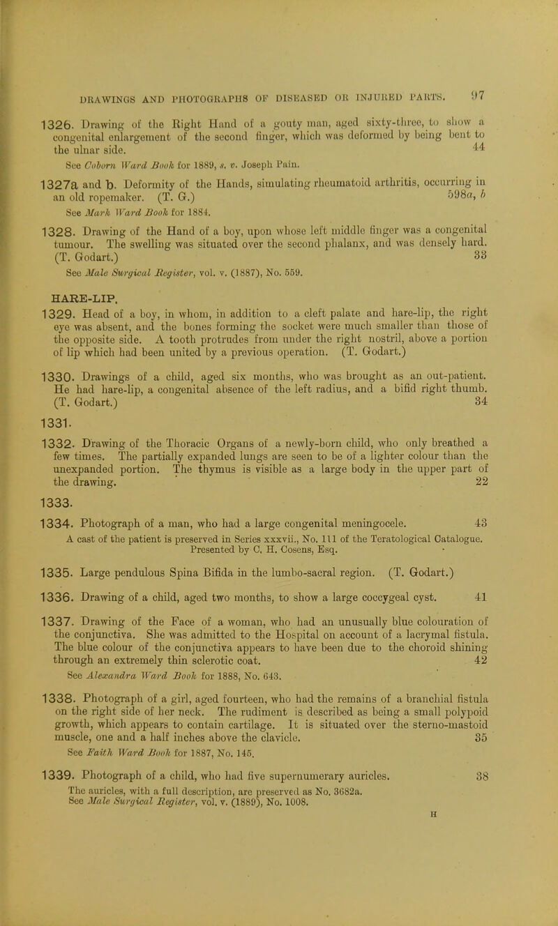 1326. Drawing of the Right Hund of a gouty man, aged sixty-three, to show a congenital enlargement of the second ringer, which was do formed by being bent to the ulnar side. 44 See Coborn Ward Book for 1889, s. v. Joseph Pain. 1327a and b. Deformity of the Hands, simulating rheumatoid arthritis, occurring in an old ropemaker. (T. G.) 598a, b See Mark Ward Book for 1884. 1328. Drawing of the Hand of a boy, upon whose left middle finger was a congenital tumour. The swelling was situated over the second phalanx, and was densely hard. (T. Godart.) 33 See Male Surgical Register, vol. v. (1887), No. 559. HARE-LIP. 1329. Head of a boy, in whom, in addition to a cleft palate and hare-lip, the right eye was absent, and the bones forming the socket were much smaller than those of the opposite side. A tooth protrudes from under the right nostril, above a portion of lip which had been united by a previous operation. (T. Godart.) 1330. Drawings of a child, aged six months, who was brought as an out-patient. He had hare-Hp, a congenital absence of the left radius, and a bifid right thumb. (T. Godart.) 34 1331. 1332. Drawing of the Thoracic Organs of a newly-born child, who only breathed a few times. The partially expanded lungs are seen to be of a lighter colour than the unexpanded portion. The thymus is visible as a large body in the upper part of the drawing. 22 1333. 1334. Photograph of a man, who had a large congenital meningocele. 43 A cast of the patient is preserved in Series xxxvti., No. Ill of the Teratological Catalogue. Presented by C. H. Cosens, Esq. 1335. Large pendulous Spina Bifida in the lurnbo-sacral region. (T. Godart.) 1336. Drawing of a child, aged two months, to show a large coccygeal cyst. 41 1337. Drawing of the Face of a woman, who had an unusually blue colouration of the conjunctiva. She was admitted to the Hospital on account of a lacrymal fistula. The blue colour of the conjunctiva appears to have been due to the choroid shining through an extremely thin sclerotic coat. 42 See Alexandra Ward Booh for 1888, No. 643. 1338. Photograph of a girl, aged fourteen, who had the remains of a branchial fistula on the right side of her neck. The rudiment is described as being a small polypoid growth, which appears to contain cartilage. It is situated over the steruo-mastoid muscle, one and a half inches above the clavicle. 35 See Faith Ward Book for 1887, No. 146. 1339. Photograph of a child, who had five supernumerary auricles. 38 The auricles, with a full description, are preserved as No. 3G82a. See Male Surgical Register, vol. v. (1889), No. 1008.
