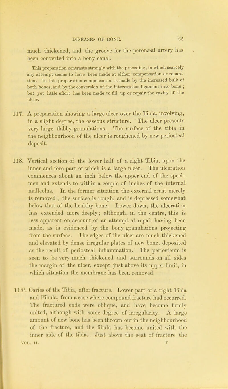 much tliickened, and tlie groove for the peronseal artery has been converted into a bony canal. This preparation contrasts strongly with the preceding, in which scarcely any attempt seems to have been made at either compensation or repara- tion. In this prepamtion compensation is made by the increased bulk of both bones, and by the conversion of the interosseous ligament into bone ; but yet little effort has been made to fill up or repair the cavity of the ulcer. 117. A preparation showing a large ulcer over the Tibia, involving, in a slight degree, the osseous structure. The ulcer presents very large flabby granidations. The surface of the tibia in the neighbourhood of the nicer is roughened by nevr periosteal deposit. 118. Vertical section of the lower half of a right Tibia, upon the inner and fore part of which is a large ulcer. The ulceration commences about an inch below the upper end of the speci- men and extends to within a couple of inches of the internal malleolus. In the fomier situation the external cmst merely is removed ; the surface is rough, and is depressed somewhat below that of the healthy bone. Lower down, the ulceration has extended more deeply; although, in the centre, this is less apparent on account of an attempt at repair having been made, as is evidenced by the bony granulations projecting from the surface. The edges of the ulcer are much thickened and elevated by dense irregular plates of new bono, deposited as the result of periosteal inflammation. The periosteum is seen to be very much thickened and surrounds on all sides the margin of the ulcer, except just above its upper limit, in which situation the membrane has been removed. 118^ Caries of the Tibia, after fracture. Lower part of a right Tibia and Fibula, from a case where compound fracture had occurred. The fractured ends were oblique, and have become firmly united, although with some degree of irregularity. A large amount of new bone has been thrown out in the neighbourhood of the fracture, and the fibula has become united with the inner side of the tibia. Just above the seat of fracture the VOL. II. F