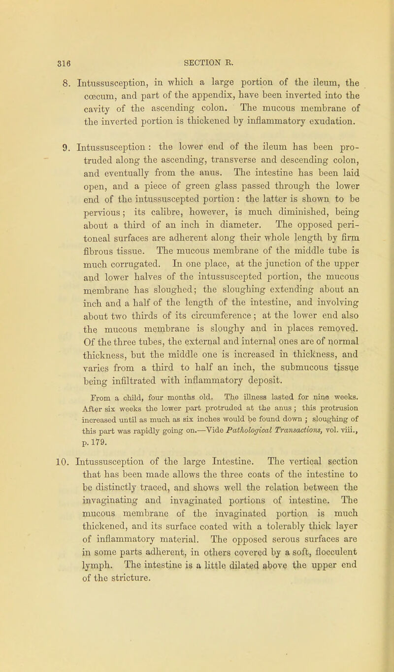 8. Intussusception, in which a large portion of the ileum, the coecum, and part of the appendix, have been inverted into the cavity of the ascending colon. The mucous membrane of the inverted portion is thickened by inflammatory exudation. 9. Intussusception : the lower end of the ileum has been pro- truded along the ascending, transverse and descending colon, and eventually from the anus. The intestine has been laid open, and a piece of green glass passed through the lower end of the intussuscepted portion : the latter is shown to be pervious; its cahbre, however, is much diminished, being about a thii'd of an inch in diameter. The opposed peri- toneal surfaces are adherent along their whole length by firm fibrous tissue. The mticous membrane of the middle tube is much corrugated. In one place, at the junction of the upper and lower halves of the intussuscepted portion, the mucous membrane has sloughed; the sloughing extending about an inch and a haK of the length of the intestine, and involving about two thirds of its cii'cumference; at the lower end also the mucous membrane is sloughy and in places removed. Of the three tubes, the external and internal ones are of nonnal thickness, but the middle one is increased in thickness, and varies from a third to half an inch, the submucous tissue being infiltrated vsith inflammatory deposit. From a cMld, four montlis old. The iUness lasted for nine weeks. After six weeks the lower part protruded at the anus; this protrusion increased until as much as six inches would be found down ; sloughing of this part was rapidly going on.—Vide Pathological Transactions, vol. viii., p. 179. 10. Intussusception of the large Intestine. The vertical section that has been made allows the three coats of the intestine to be distinctly traced, and shows well the relation between the invaginating and invaginated portions of intestine. Tlie mucous membrane of the invaginated portion is much thickened, and its surface coated with a tolerably thick layer of inflammatory material. The opposed serous surfaces are in some parts adherent, in others covered by a soft, flocculent lymph. The intestine is a little dilated above the upper end of the stricture.