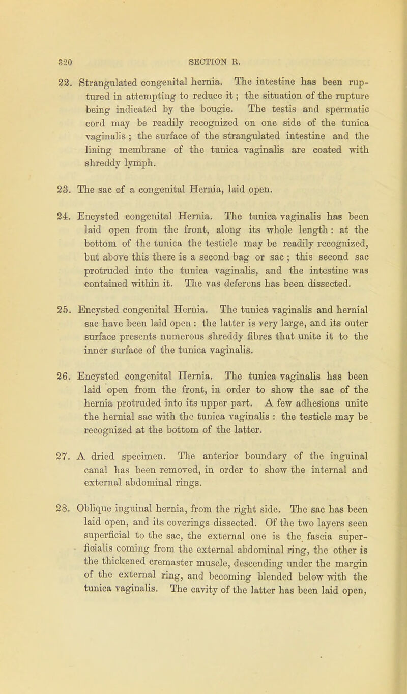 22. Strangulated congenital hernia. The intestine has been rup- tured in attempting to reduce it; the situation of the ruptm-e being indicated by the bougie. The testis and spermatic cord may be readily recognized on one side of the tunica vaginalis ; the surface of the strangulated intestine and the lining membrane of the tunica vaginalis are coated with shreddy lymph. 23. The sac of a congenital Hernia, laid open. 24. Encysted congenital Hernia. The tunica vaginalis has been laid open from the front, along its whole length: at the bottom of the tunica the testicle may be readily recognized, but above this there is a second bag or sac ; this second sac protruded into the tunica vaginalis, and the intestine was contained within it. The vas deferens has been dissected. 25. Encysted congenital Hernia. The tunica vaginalis and hernial sac have been laid open: the latter is very large, and its outer surface presents numerous shreddy fibres that unite it to the inner surface of the tunica vaginalis. 26. Encysted congenital Hernia. The tunica vaginalis has been laid open from the front, in order to show the sac of the hernia protinided into its upper part. A few adhesions unite the hernial sac with the tunica vaginahs : the testicle may be recognized at the bottom of the latter. 27. A dried specimen. The anterior boundary of the inguinal canal has been removed, in order to show the internal and external abdominal rings. 28. Oblique inguinal hernia, from the right side. The sac has been laid open, and its coverings dissected. Of the two layers seen superficial to the sac, the external one is the fascia super- fioialis coming from the external abdominal ring, the other is the thickened cremaster muscle, descending under the margin of the external ring, and becoming blended below with the tunica vaginalis. The cavity of the latter has been laid open.