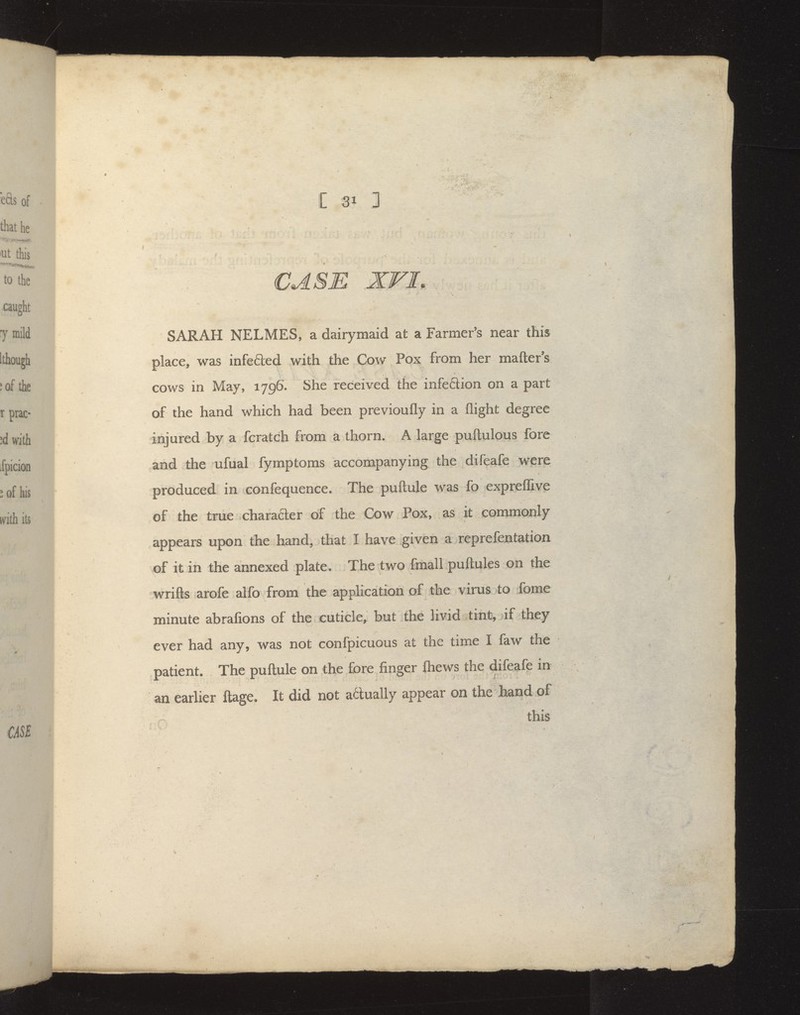 SARAH NELMES, a dairymaid at a Farmer's near this place, was infefted with the Cow Pox from her matter's cows in May, 1796. She received the infedion on a part of the hand which had been previoufly in a flight degree injured by a fcratch from a thorn. A large puftulous fore and the ufual fymptoms accompanying the difeafe were produced in confequence. The puftule was fo exprelTive of the true charaaer of the Cow Pox, as it commonly appears upon the hand, that I have given a reprefentation of it in the annexed plate. The two fraall puftules on the wrifts arofe alfo from the application of the virus to fome minute abrafions of the cuticle, but the livid tint, if they ever had any, was not confpicuous at the time I faw the patient. The puftule on the £3re finger fliews the difeafe in an earlier ftage. It did not a6luaily appear on the hand of this