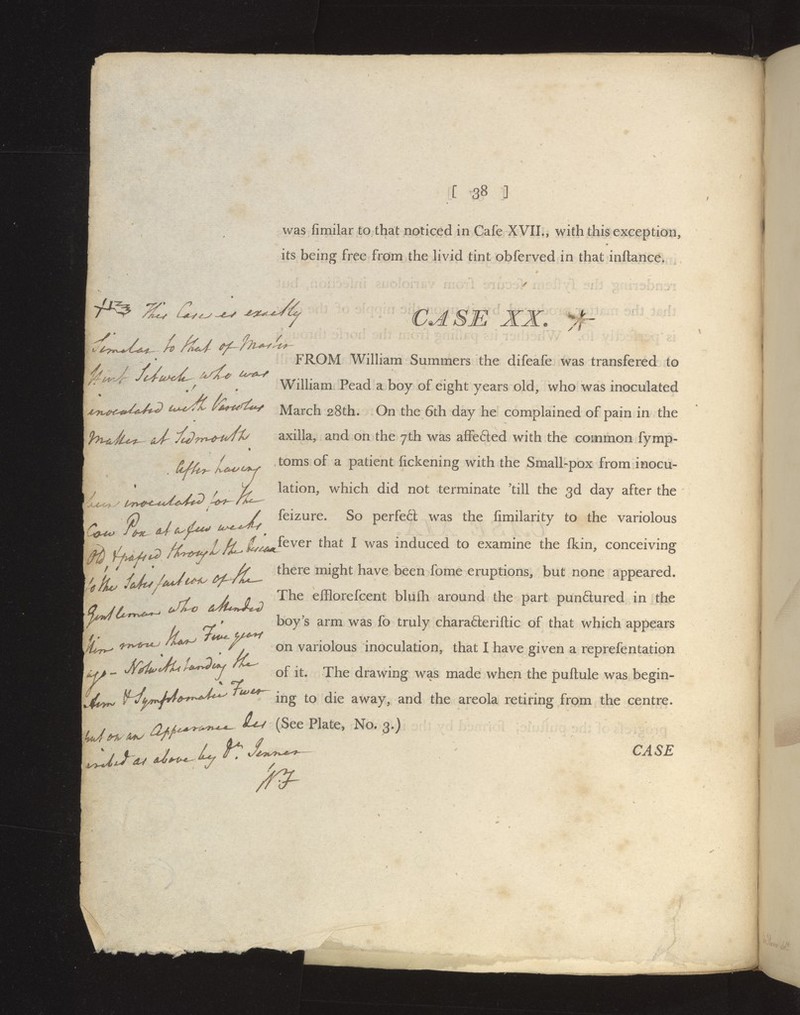 » was fimilar to that noticed in Cafe XVIL, with this exception, its being free from the livid tint obferved in that inftance. 7^ CASB XX. /r / / ^—' FROM William Summers the difeafe was transfered to William Pead a boy of eight years old, who was inoculated ,1^^,^,,^^^^ ^-^^ March 28th. On the 6th day he complained of pain in the axilla, and on the 7th was affefted with the common fymp- toms of a patient fickening with the Small-pox from inocu- lation, which did not terminate 'till the 3d day after the feizure. So perfetl was the fimilarity to the variolous £^^^fever that I was induced to examine the fkin, conceiving ; y . > / /f there might have been fome eruptions, but none appeared. jt-o ^aJuJLi) '^^^ efflorefcent bluflh around the part punftured in the boy's arm was fo truly charafleriftic of that which appears on variolous inoculation, that I have given a reprefentation of it. The drawing was made when the puftule was begin- ing to die away, and the areola retiring from the centre. 9^ d^f^ ^^-^^^ / (See Plate, No. 3.) CASE