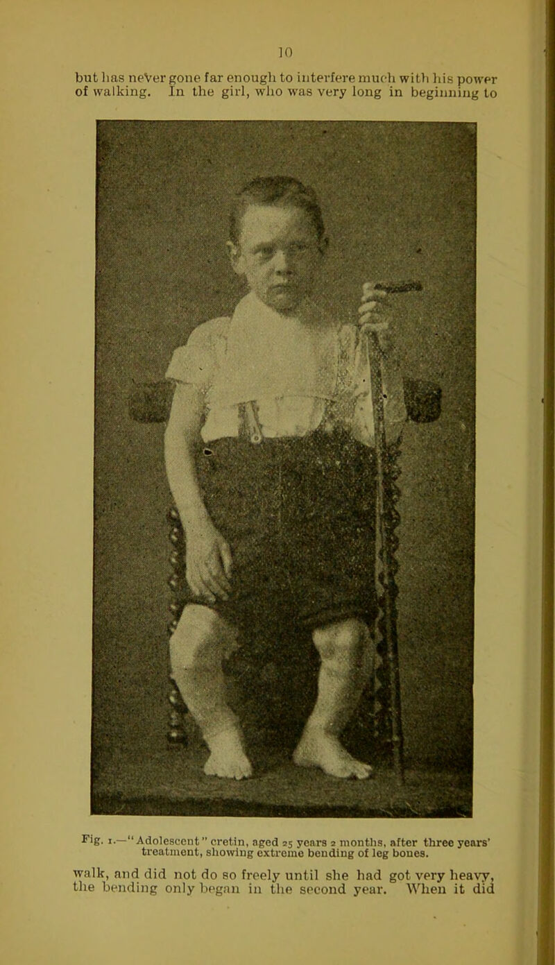 but lias neVer gone far enough to interfere much with his power of walking. In the girl, who was very long in beginning to FiS- *•—“ Adolescent ” cretin, aged 25 years 2 months, after three years’ treatment, showing extreme bending of leg bones. walk, and did not do so freely until she had got very heavy, the bending only began in the second year. When it did