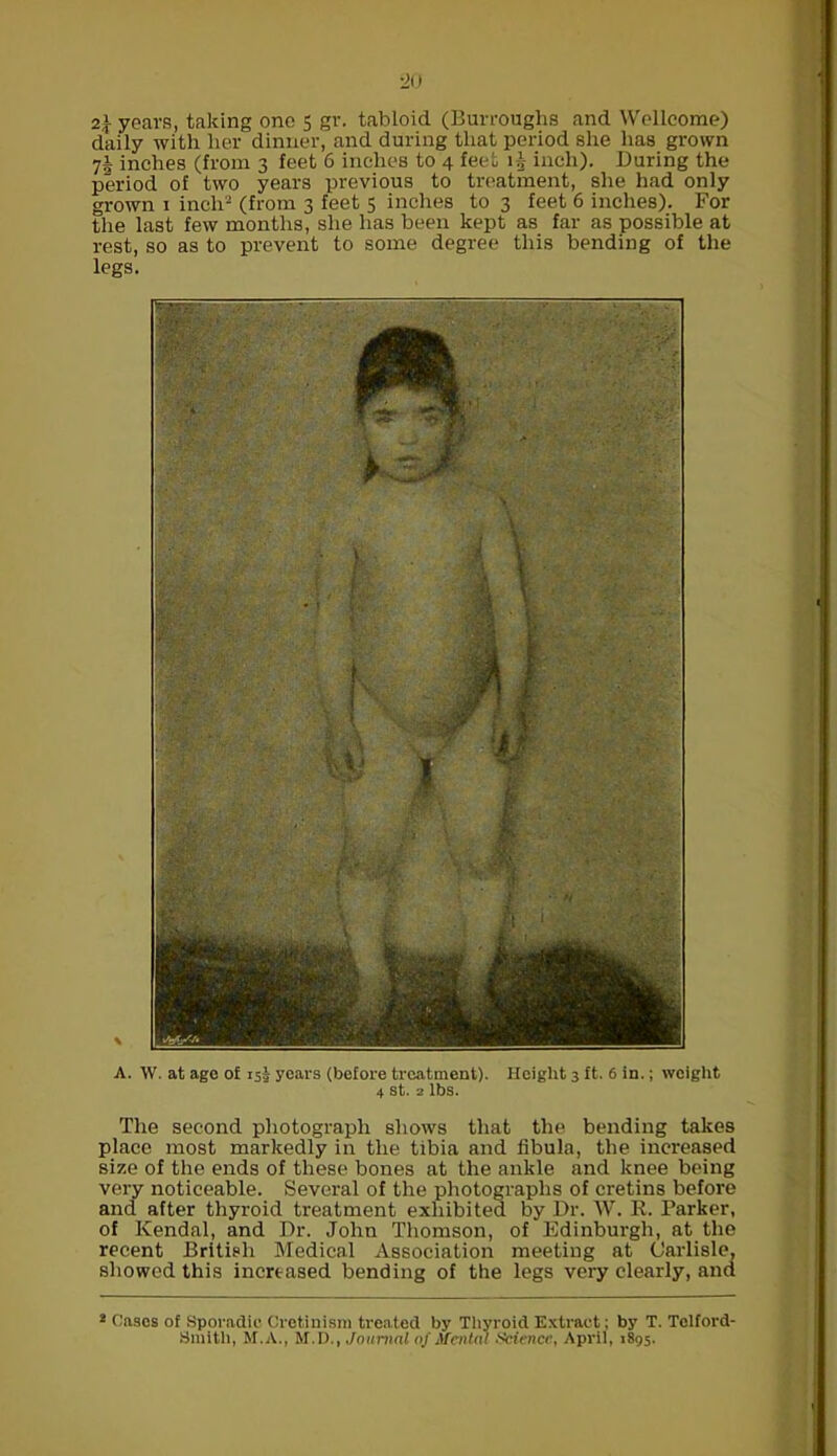 2\ years, taking one 5 gr. tabloid (Burroughs and Wellcome) daily with her dinner, and during that period she has grown 7§ inches (from 3 feet 6 inches to 4 feet 1J inch). During the period of two years previous to treatment, she had only grown 1 inch2 (from 3 feet 5 inches to 3 feet 6 inches). For the last few months, she has been kept as far as possible at rest, so as to prevent to some degree this bending of the legs. A. W. at age of 153 years (before treatment). Height 3 ft. 6 in.; weight 4 st. 2 lbs. The second photograph shows that the bending takes place most markedly in the tibia and fibula, the increased size of the ends of these bones at the ankle and knee being very noticeable. Several of the photographs of cretins before and after thyroid treatment exhibited by Dr. W. R. Parker, of Kendal, and Dr. John Thomson, of Edinburgh, at the recent British Medical Association meeting at Carlisle, showed this increased bending of the legs very clearly, and * Cases of Sporadic Cretinism treated by Thyroid Extract; by T. Tclford- 3mith, M.A., M.D., Journal of Mental Science, April, 1895.