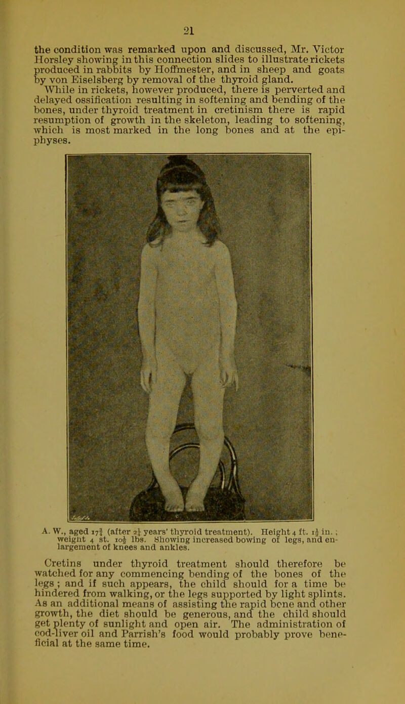 the condition was remarked upon and discussed, Mr. Victor Horsley showing in this connection slides to illustrate rickets produced in rabbits by Hoflmester, and in sheep and goats by von Eiselsberg by removal of the thyroid gland. While in rickets, however produced, there is perverted and delayed ossification resulting in softening and bending of the bones, under thyroid treatment in cretinism there is rapid resumption of growth in the skeleton, leading to softening, which is most marked in the long bones and at the epi- physes. A. W., aged 17J (after 2} years’ thyroid treatment). Height 4 ft. in. ; weight 4 st. 10J lbs. Showing increased bowing of legs, and en- largement of knees and ankles. Cretins under thyroid treatment should therefore be watched for any commencing bending of the bones of the legs ; and if such appears, the child should for a time be hindered from walking, or the legs supported by light splints. As an additional means of assisting tne rapid bone and other growth, the diet should be generous, and the child should get plenty of sunlight and open air. The administration of cod-liver oil and Parrish’s food would probably prove bene- ficial at the same time.