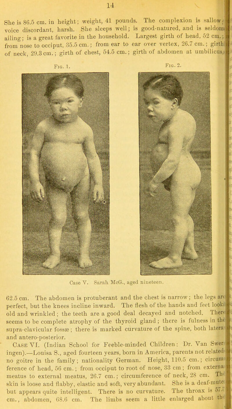 She is 86.5 cm. in height; weight, 41 pounds. The complexion is sallow; voice discordant, harsh. She sleeps well; is good-natured, and is seldom, ailing; is a great favorite in the household. Largest girth of head, 52 cm.; from nose to occiput, 35.5 cm.; from ear to ear over vertex, 26.7 cm.; girth of neck, 29.3cm.; girth of chest, 54.5 cm.; girth of abdomen at umbilicus, Fig. 1. Fig. 2. Case V. Sarah McG., aged nineteen. 62.5 cm. The abdomen is protuberant and the chest is narrow ; the legs an perfect, but the knees incline inward. The flesh of the hands and feet look, old and wrinkled ; the teeth are a good deal decayed and notched. Then seems to be complete atrophy of the thyroid gland ; there is fulness in thi supra-clavicular fossae; there is marked curvature of the spine, both latera and antero-posterior. Case VI. (Indian School for Feehle-minded Children: Dr. Van Swer ingen).—Louisa S., aged fourteen years, born in America, parents not related no goitre in the family; nationality German. Height, 110.5 cm.; circuiu ference of head, 56 cm.; from occiput to root of nose, 33 cm ; from externa meatus to external meatus, 26.7 cm.; circumference of neck, 28 cm. Tin skin is loose and flabby, elastic and soft, very abundant. She is a deaf-mute but appears quite intelligent. There is no curvature. The throax is 57-' cm., abdomen, 68.6 cm. The limbs seem a little enlarged about tin