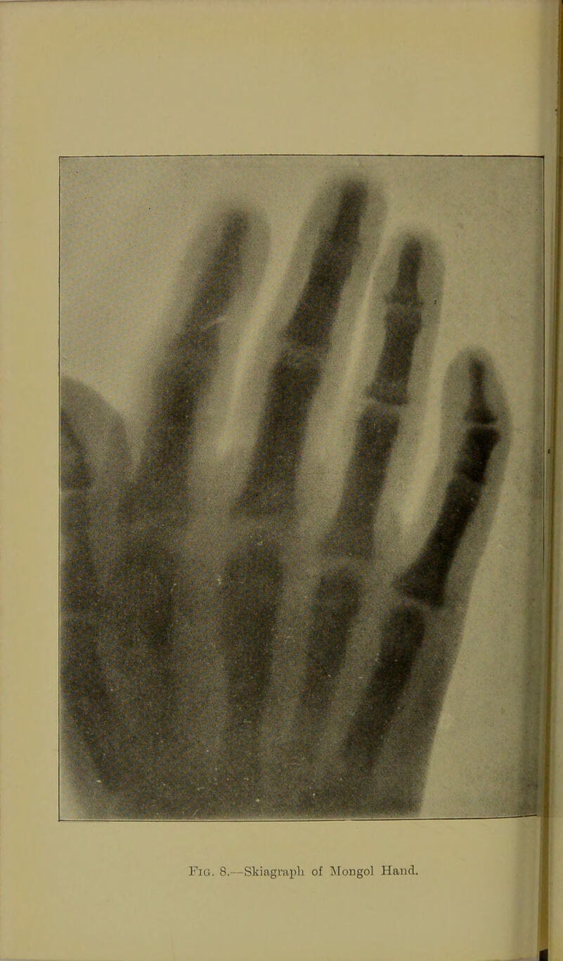 Fig. 8.—Skiagraph of Mongol Hand.