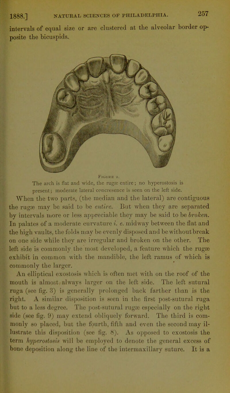 intervals of equal size or are clustered at the alveolar border op- posite the bicuspids. FiGUltE 3. The arch is flat and wide, the ruga: entire; no hyperostosis is present; moderate lateral concresence is seen on the left side. When the two parts, (the median and the lateral) are contiguous the ruga? may be said to be entire. But when they are separated by intervals more or less appreciable they may be said to be broken. In palates of a moderate curvature i. e. midway between the flat and the high vaults, the folds may be evenly disposed and be without break on one side while they are irregular and broken on the other. The left side is commonly the most developed, a feature which the rugae exhibit in common with the mandible, the left ramus of which is commonly the larger. An elliptical exostosis which is often met with on the roof of the mouth is almost/always larger on the left side. The left sutural ruga (see fig. 3) is generally prolonged back farther than is the right. A similar disposition is seen in the first post-sutural ruga but to a less degree. The post-sutural ruga; especially on the right side (see fig. 9) may extend obliquely forward. The third is com- monly so placed, but the fourth, fiftli and even the second may il- lustrate this disposition (see fig. 8). As opposed to exostosis the term hyperostosis will be employed to denote the general excess of bone deposition along the line of the intermaxillary suture. It is a