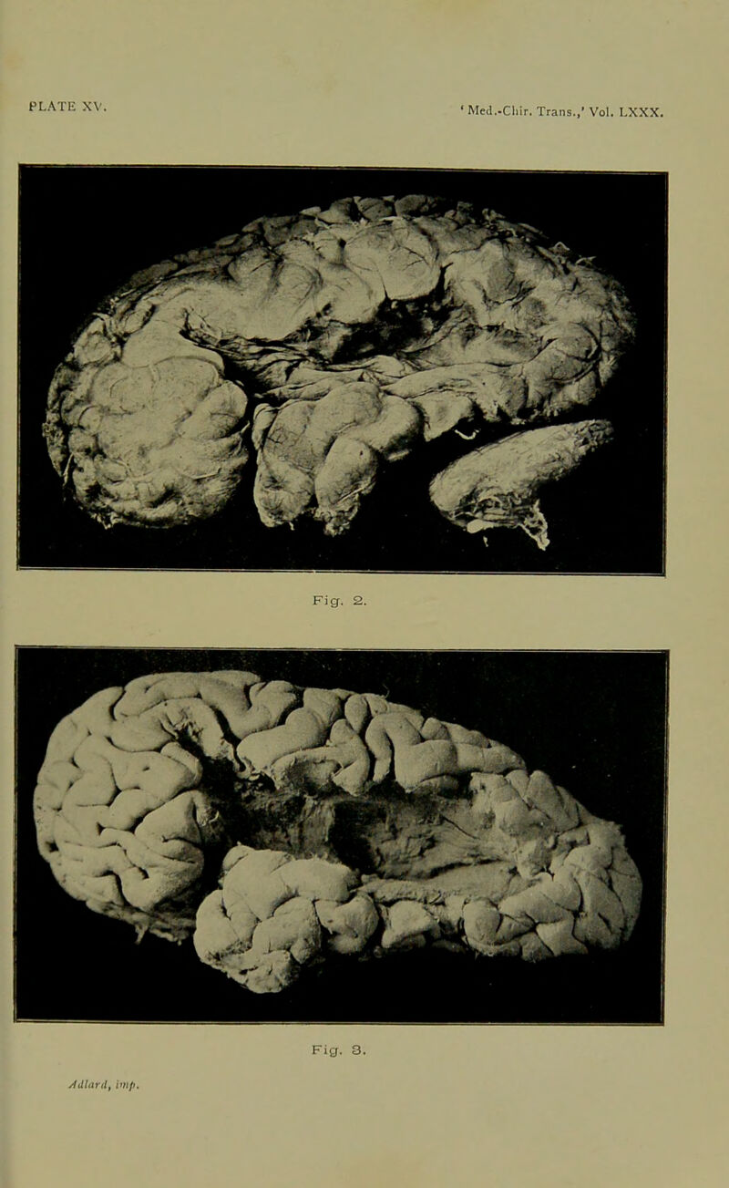 PLATE XV. ‘ Med.-Chir. Trans.,’ Vol. LXXX. Fig. 2. f v k - Fig. 3. Adlard, imp.