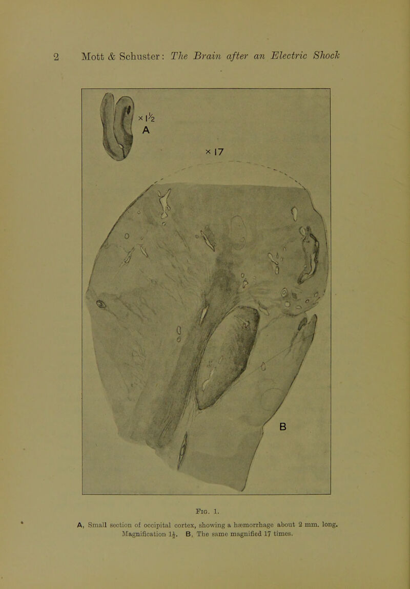 Fig. 1. A, Small section of occipital cortex, showing a haemorrhage about 2 mm. long. Magnification 1£. B, The same magnified 17 times.