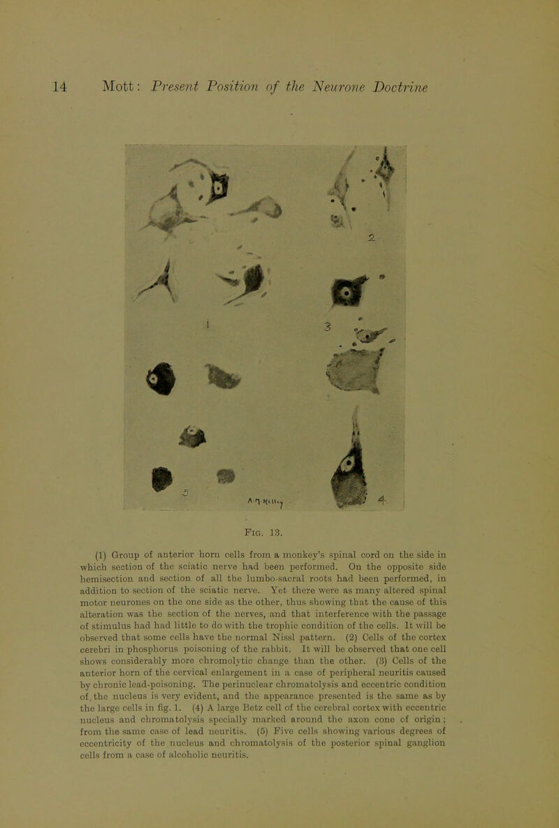 Fig. 13. (1) Group of anterior horn cells from a monkey’s spinal cord on the side in which section of the sciatic nerve had been performed. On the opposite side hemisection and section of all the lumbo-sacral roots had been performed, in addition to section of the sciatic nerve. Yet there were as many altered spinal motor neurones on the one side as the other, thus showing that the cause of this alteration was the section of the nerves, and that interference with the passage of stimulus had had little to do with the trophic condition of the cells. It will be observed that some cells have the normal Nissl pattern. (2) Cells of the cortex cerebri in pihosphorus poisoning of the rabbit. It will be observed that one cell shows considerably more chromolytic change than the other. (3) Cells of the anterior horn of the cervical enlargement in a case of peripheral neuritis caused by chronic lead-poisoning. The perinuclear chromatolysis and eccentric condition of, the nucleus is veiy evident, and the appearance presented is the same as by the large cells in fig. 1. (4) A large Betz cell of the cerebral cortex with eccentric nucleus and chromatolysis specially marked around tho axon cone of origin ; from the same case of lead neuritis. (5) Five cells showing various degrees of eccentricity of the nucleus and chromatolysis of the posterior spinal ganglion cells from a case of alcoholic neuritis.