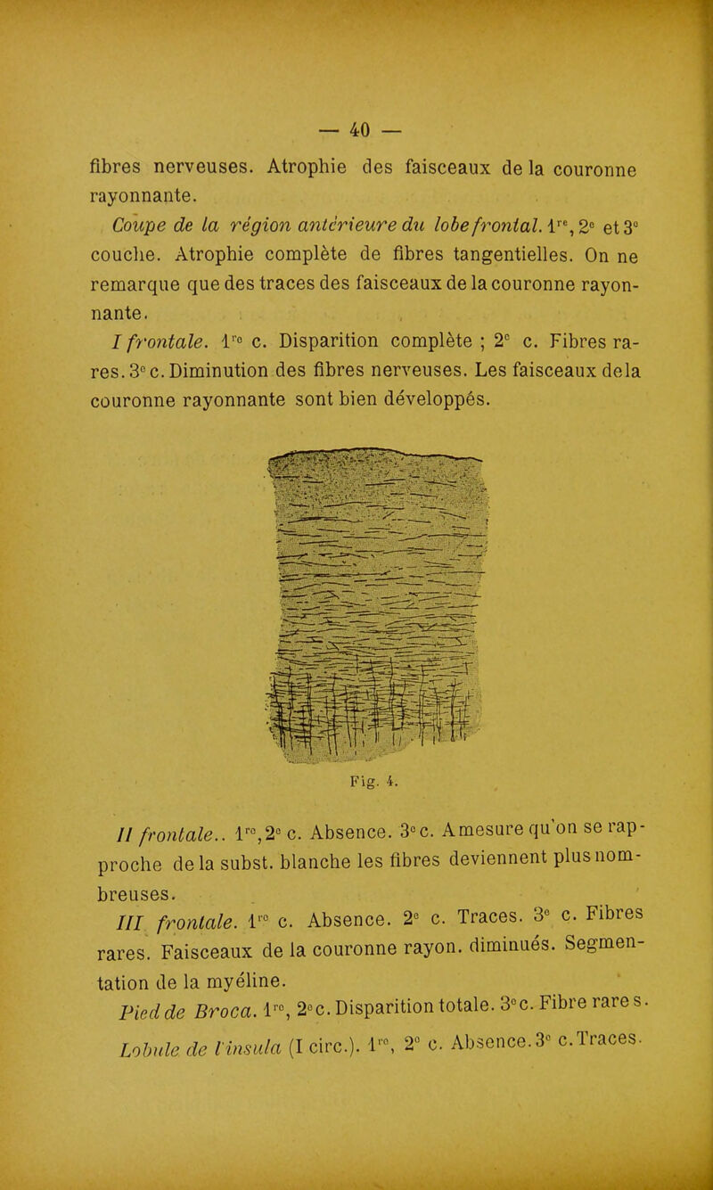 fibres nerveuses. Atrophie des faisceaux de la couronne rayonnante. Coupe de la région anterieure du lobe frontal. lrc, 2° et 3° couche. Atrophie complète de fibres tangentielles. On ne remarque que des traces des faisceaux de la couronne rayon- nante. I frontale. lr° c. Disparition complète ; 2e c. Fibres ra- res. 3° c. Diminution des fibres nerveuses. Les faisceaux delà couronne rayonnante sont bien développés. Fig. 4. // frontale.. lro,2°c. Absence. 3°c. Amesure qu on se rap- proche delà subst. blanche les fibres deviennent plus nom- breuses. III frontale. I1'0 c. Absence. 2° c. Traces. 3° c. Fibres rares. Faisceaux de la couronne rayon, diminués. Segmen- tation de la myéline. Pied de Broca. lrc, 2°c. Disparition totale. 3° c. Fibre rares. Lobule de l'insula (I cire.). lr0, 2° c. Absence.3° c.Traces.