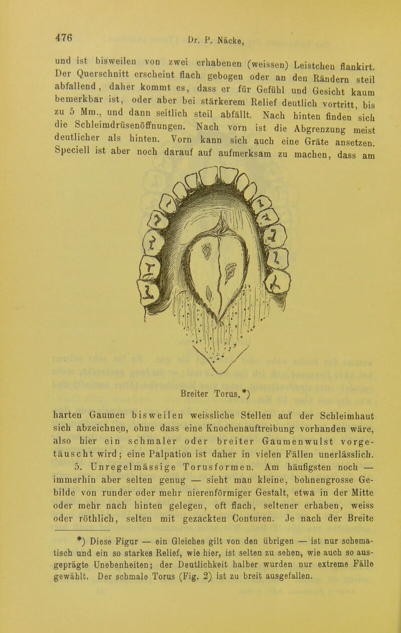 und ist bisweilen von zwei erhabenen (weissen) Leisteben flaukirt Der Querschnitt erscheint flach gebogen oder an den Rändern steil abfallend, daher kommt es, dass er für Gefühl und Gesicht kaum bemerkbar ist, oder aber bei stärkerem Relief deutlich vortritt bis zu 5 Mm., und dann seitlich steil abfällt. Nach hinten finden 'sich die Schleimdrüsenöffnungen. Nach vorn ist die Abgrenzung meist deutlicher als hinten. Vorn kann sich auch eine Gräte ansetzen. Speciell ist aber noch darauf auf aufmerksam zu machen, dass am Breiter Torus.*) harten Gaumen bisweilen weissliche Stellen auf der Schleimhaut sich abzeichnen, ohne dass eine Knochenauftreibung vorhanden wäre, also hier ein schmaler oder breiter Gaumenwulst vorge- täuscht wird; eine Palpation ist daher in vielen Fällen unerlässlich. 5. Unregelmässige Torus formen. Am häufigsten noch — immerhin aber selten genug — sieht man kleine, bohnengrosse Ge- bilde von runder oder mehr nierenförmiger Gestalt, etwa in der Mitte oder mehr nach hinten gelegen, oft flach, seltener erhaben, weiss oder röthlich, selten mit gezackten Conturen. Je nach der Breite *) Diese Figur — ein Gleiches gilt von den übrigen — ist nur schema- tisch und ein so starkes Relief, wie hier, ist selten zu sehen, wie auch so aus- geprägte Unebenheiten; der Deutlichkeit halber wurden nur extreme Fälle gewählt. Der schmale Torus (Fig. 2) ist zu breit ausgefallen.