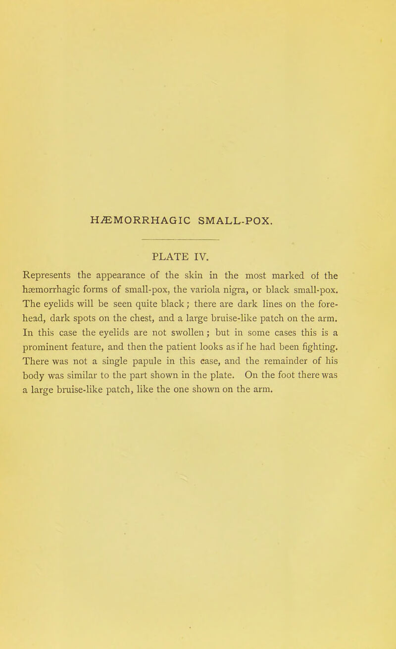 PLATE IV. Represents the appearance of the skin in the most marked of the haemorrhagic forms of small-pox, the variola nigra, or black small-pox. The eyelids will be seen quite black; there are dark lines on the fore- head, dark spots on the chest, and a large bruise-like patch on the arm. In this case the eyelids are not swollen; but in some cases this is a prominent feature, and then the patient looks as if he had been fighting. There was not a single papule in this case, and the remainder of his body was similar to the part shown in the plate. On the foot there was a large bruise-like patch, like the one shown on the arm.