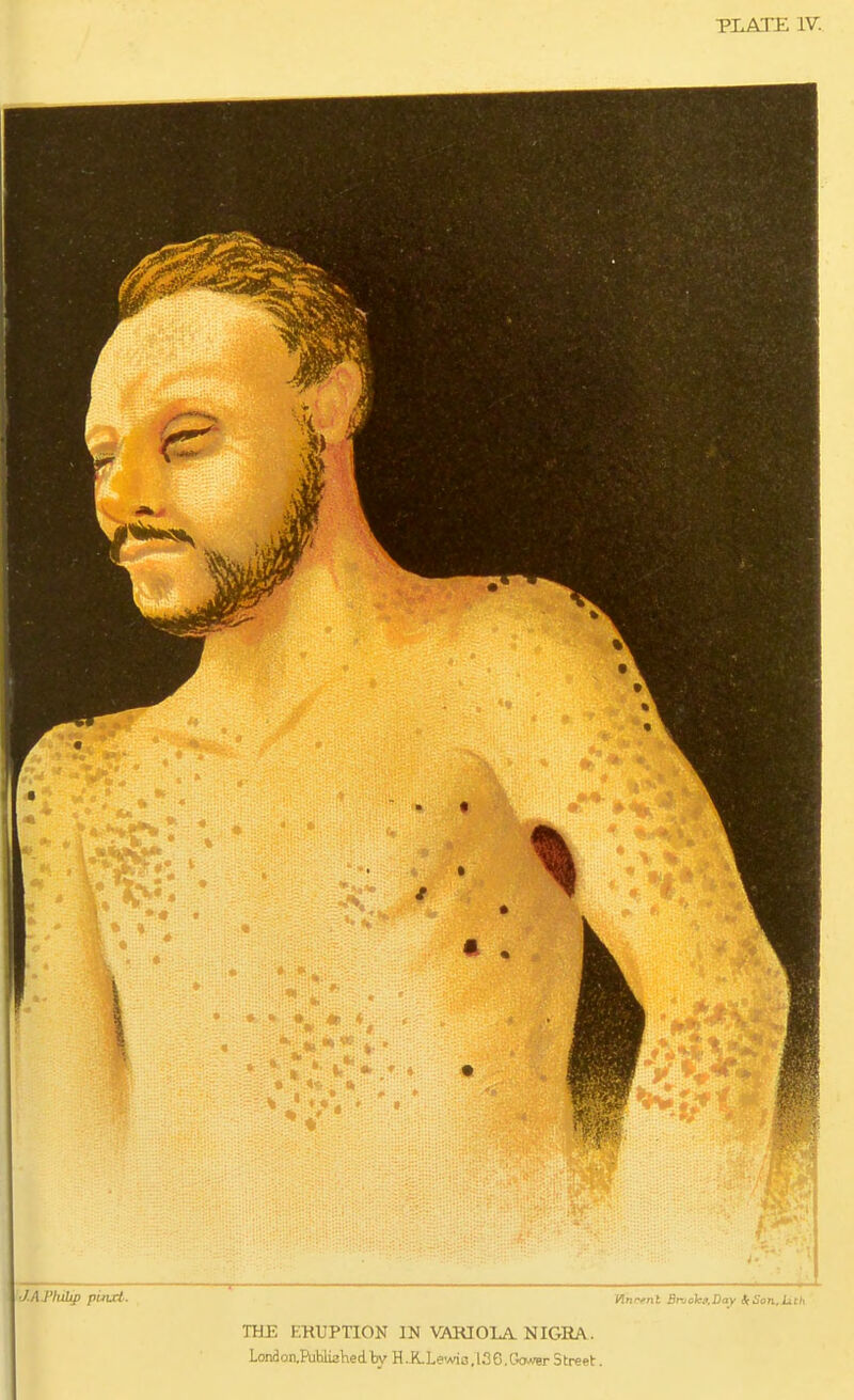PLATE IV. dAJ^fuUp pinct. I PTri'vni Brvohfi.Day Son.Lich THE KHUPnON IN VAKIOLA. NIGRA. LondonjPublisKedljv H.K..L6'Aii3,l36.Gc>ver Street.