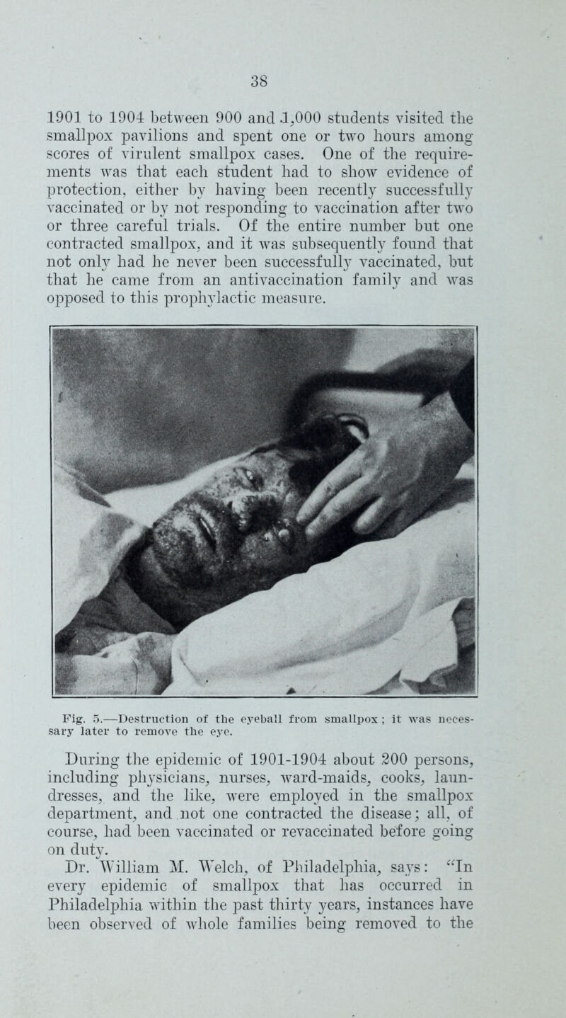 1901 to 1904 between 900 and .1,000 students visited the smallpox pavilions and spent one or two hours among scores of virulent smallpox cases. One of the require- ments was that each student had to show evidence of protection, either by having been recently successfully vaccinated or by not responding to vaccination after two or three careful trials. Of the entire number but one contracted smallpox, and it was subsequently found that not onfy had he never been successfully vaccinated, but that he came from an antivaccination family and was opposed to this prophylactic measure. Fig. 5.—Destruction of the eyeball from smallpox ; it was neces- sary later to remove the eye. During the epidemic of 1901-1904 about 200 persons, including physicians, nurses, ward-maids, cooks, laun- dresses, and the like, were employed in the smallpox department, and not one contracted the disease; all, of course, had been vaccinated or revaccinated before going on duty. Dr. William M. Wrelch, of Philadelphia, says: “In every epidemic of smallpox that has occurred in Philadelphia within the past thirty years, instances have been observed of whole families being removed to the