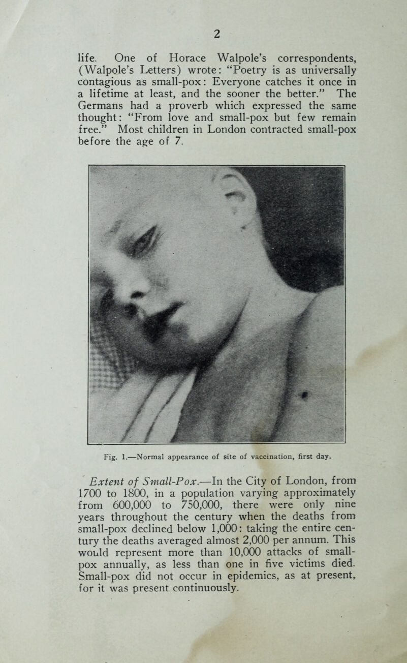 life. One of Horace Walpole’s correspondents, (Walpole’s Letters) wrote: “Poetry is as universally contagious as small-pox: Everyone catches it once in a lifetime at least, and the sooner the better.” The Germans had a proverb which expressed the same thought: “From love and small-pox but few remain free.” Most children in London contracted small-pox before the age of 7. Fig. 1.—Normal appearance of site of vaccination, first day. Extent of Small-Pox.—In the City of London, from 1700 to 1800, in a population varying approximately from 600,000 to 750,000, there were only nine years throughout the century when the deaths from small-pox declined below 1,000: taking the entire cen- tury the deaths averaged almost 2,000 per annum. This would represent more than 10,000 attacks of small- pox annually, as less than one in five victims died. Small-pox did not occur in epidemics, as at present, for it was present continuously.