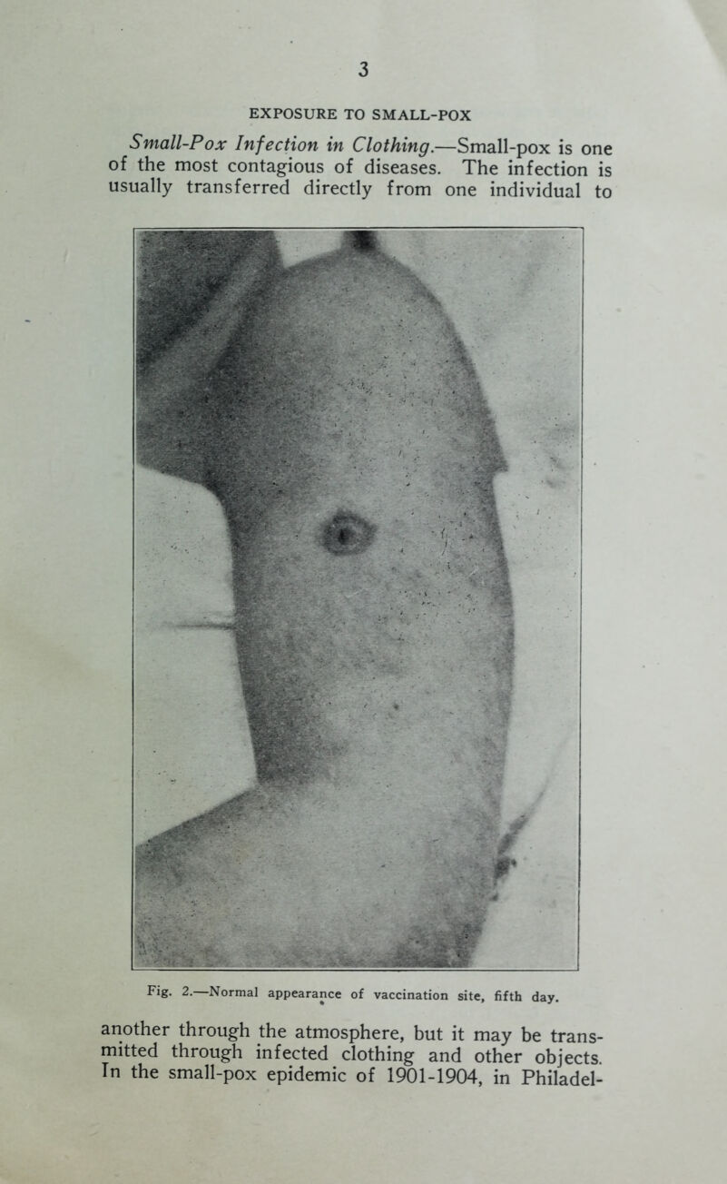 EXPOSURE TO SMALL-POX Small-Pox Infection in Clothing.—Small-pox is one of the most contagious of diseases. The infection is usually transferred directly from one individual to Fig. 2.—Normal appearance of vaccination site, fifth day. another through the atmosphere, but it may be trans- mitted through infected clothing and other objects. In the small-pox epidemic of 1901-1904, in Philadel-