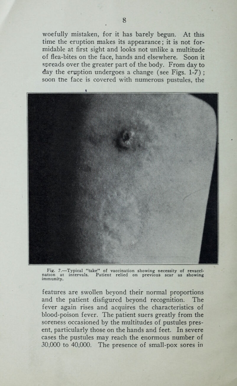 woefully mistaken, for it has barely begun. At this time the eruption makes its appearance; it is not for- midable at first sight and looks not unlike a multitude of flea-bites on the face, hands and elsewhere. Soon it spreads over the greater part of the body. From day to day the eruption undergoes a change (see Figs. 1-7) ; soon the face is covered with numerous pustules, the Fig. 7.—Typical “take” of vaccination showing necessity of revacci- nation at intervals. Patient relied on previous scar as showing immunity. features are swollen beyond their normal proportions and the patient disfigured beyond recognition. The fever again rises and acquires the characteristics of blood-poison fever. The patient suers greatly from the soreness occasioned by the multitudes of pustules pres- ent, particularly those on the hands and feet. In severe cases the pustules may reach the enormous number of 30,000 to 40,000. The presence of small-pox sores in