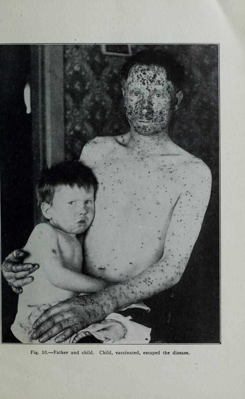 Fig. 10.—Father and child. Child, vaccinated, escaped the disease.