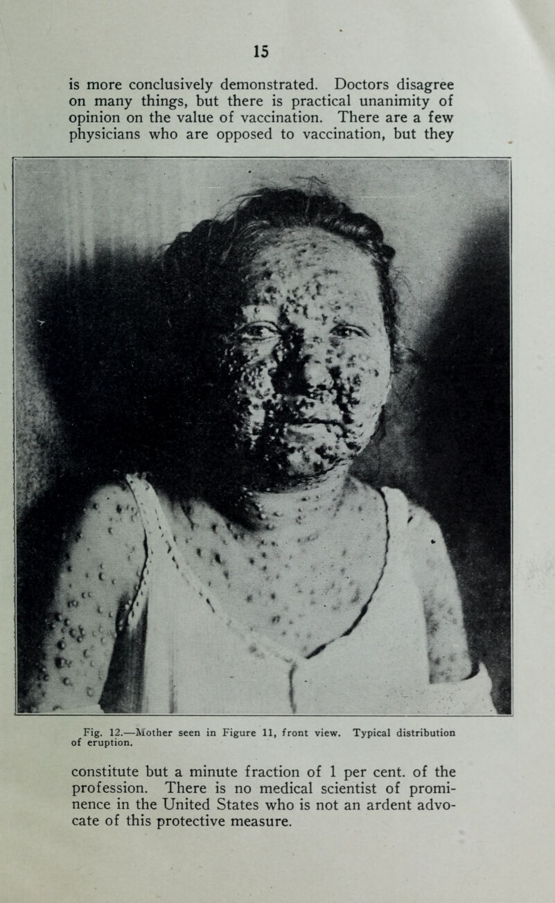 is more conclusively demonstrated. Doctors disagree on many things, but there is practical unanimity of opinion on the value of vaccination. There are a few physicians who are opposed to vaccination, but they Fig. 12.—Mother seen in Figure 11, front view. Typical distribution of eruption. constitute but a minute fraction of 1 per cent, of the profession. There is no medical scientist of promi- nence in the United States who is not an ardent advo- cate of this protective measure.