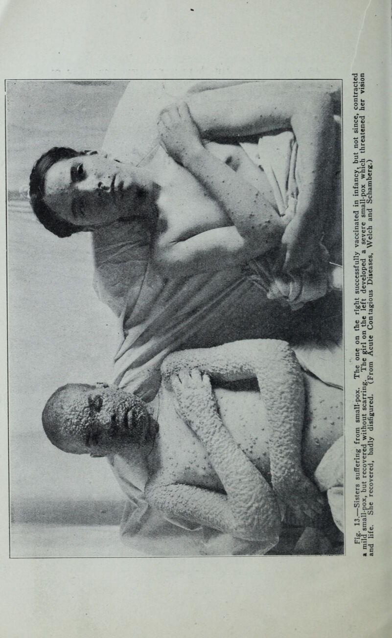 Fig. 13.—Sisters suffering from small-pox. The one on the right successfully vaccinated in infancy,^ but not since, contracted a mild small-pox, but recovered without scarring. The girl on the left developed a severe small-pox which threatened her vision and life. Sne recovered, badly disfigured. (From Acute Contagious Diseases, Welch and Schamberg.)