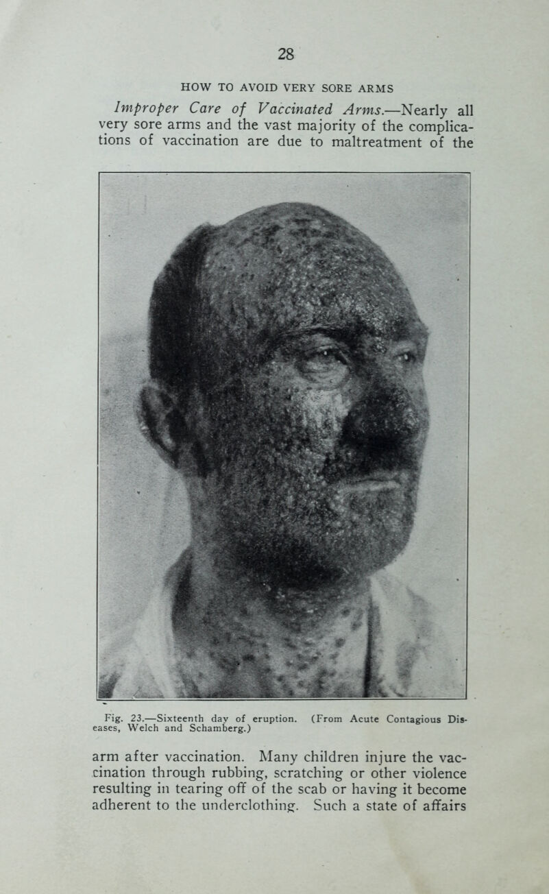 HOW TO AVOID VERY SORE ARMS Improper Care of Vaccinated Arms.—Nearly all very sore arms and the vast majority of the complica- tions of vaccination are due to maltreatment of the Fig. 23.—Sixteenth day of eruption. (From Acute Contagious Dis- eases, Welch and Schamberg.) arm after vaccination. Many children injure the vac- cination through rubbing, scratching or other violence resulting in tearing ofif of the scab or having it become adherent to the underclothing. Such a state of affairs