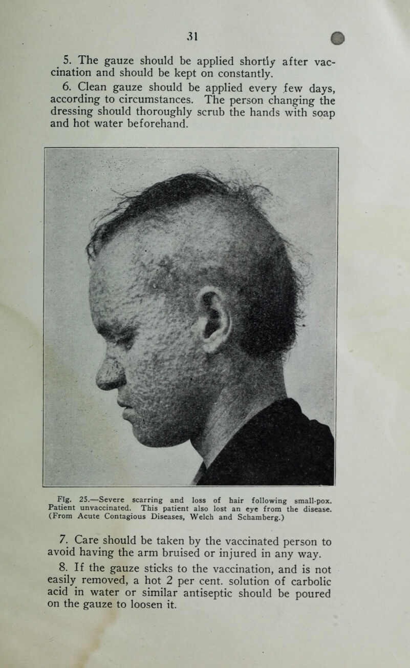 ^ 5. The gauze should be applied shortly after vac- cination and should be kept on constantly. 6. Clean gauze should be applied every few days, according to circumstances. The person changing the dressing should thoroughly scrub the hands with soap and hot water beforehand. Fig. 25.—Severe scarring and loss of hair following small-pox. Patient unvaccinated. This patient also lost an eye from the disease. (From Acute Contagious Diseases, Welch and Schamberg.) 7. Care should be taken by the vaccinated person to avoid having the arm bruised or injured in any way. 8. If the gauze sticks to the vaccination, and is not easily removed, a hot 2 per cent, solution of carbolic acid in water or similar antiseptic should be poured on the gauze to loosen it.