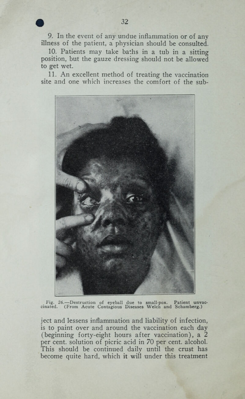 9. In the event of any undue inflammation or of any illness of the patient, a physician should be consulted. 10. Patients may take baths in a tub in a sitting position, but the gauze dressing should not be allowed to get wet. 11. An excellent method of treating the vaccination site and one which increases the comfort of the sub- Fig. 26.—Destruction of eyeball due to small-pox. Patient unvac- cinated. (From Acute Contagious Diseases Welch and Schamberg.) ject and lessens inflammation and liability of infection, is to paint over and around the vaccination each day (beginning forty-eight hours after vaccination), a 2 per cent, solution of picric acid in 70 per cent, alcohol. This should be continued daily until the crust has become quite hard, which it will under this treatment