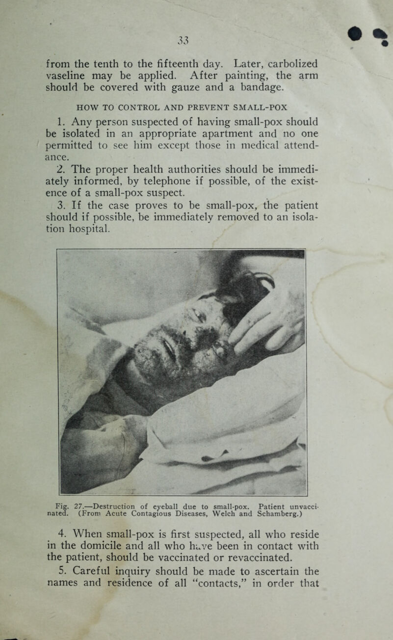 from the tenth to the fifteenth day. Later, carbolized vaseline may be applied. After painting, the arm should be covered with gauze and a bandage. HOW TO CONTROL AND PREVENT SMALL-POX 1. Any person suspected of having small-pox should be isolated in an appropriate apartment and no one permitted to see him except those in medical attend- ance. 2. The proper health authorities should be immedi- ately informed, by telephone if possible, of the exist- ence of a small-pox suspect. 3. If the case proves to be small-pox, the patient should if possible, be immediately removed to an isola- tion hospital. Fig. 27.—Destruction of eyeball due to small-pox. Patient unvacci- nated. (From Acute Contagious Diseases, Welch and Schamberg.) 4. When small-pox is first suspected, all who reside in the domicile and all who have been in contact with the patient, should be vaccinated or revaccinated. 5. Careful inquiry should be made to ascertain the names and residence of all “contacts,” in order that