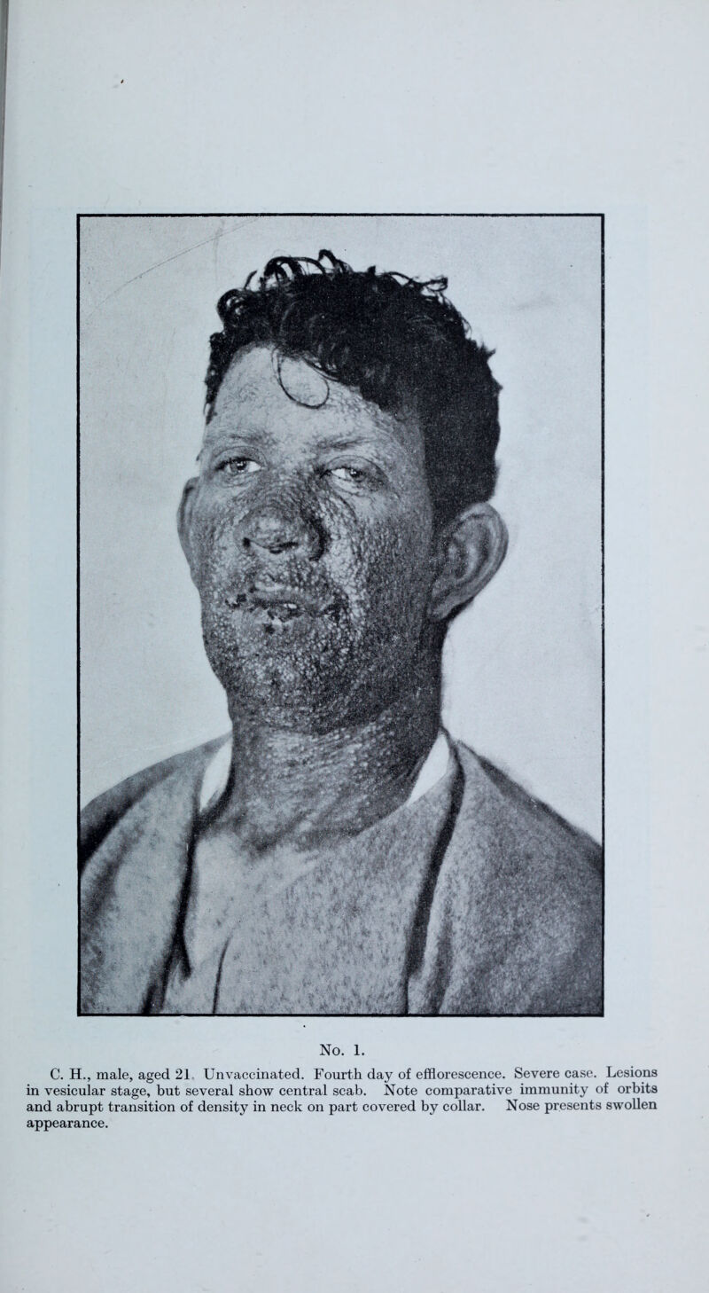 C. H., male, aged 21 Unvaccinated. Fourth day of efflorescence. Severe case. Lesions in vesicular stage, but several show central scab. Note comparative immunity of orbits and abrupt transition of density in neck on part covered by collar. Nose presents swollen appearance.