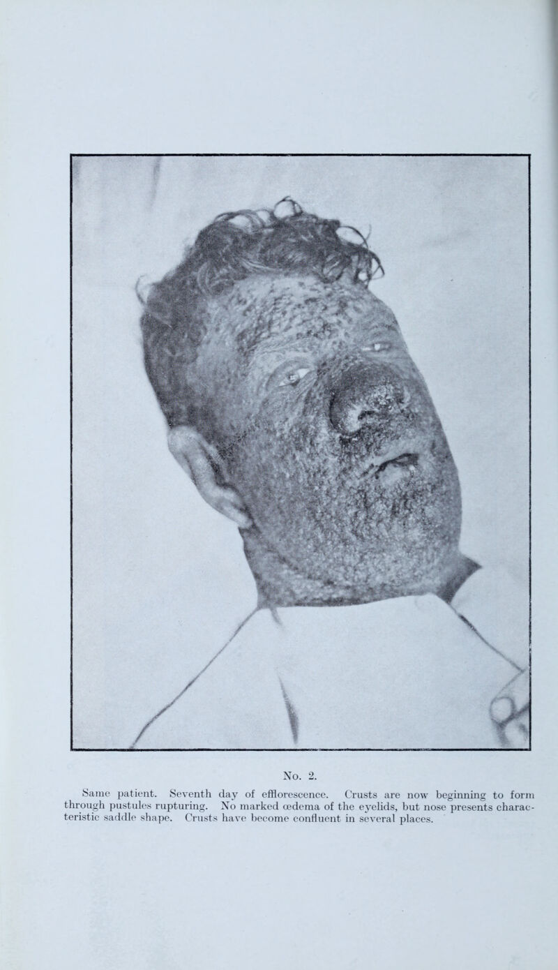 Same patient. Seventh day of efflorescence. Crusts are now beginning to form through pustules rupturing. No marked oedema of the eyelids, but nose presents charac- teristic saddle shape. Crusts have become confluent in several places.