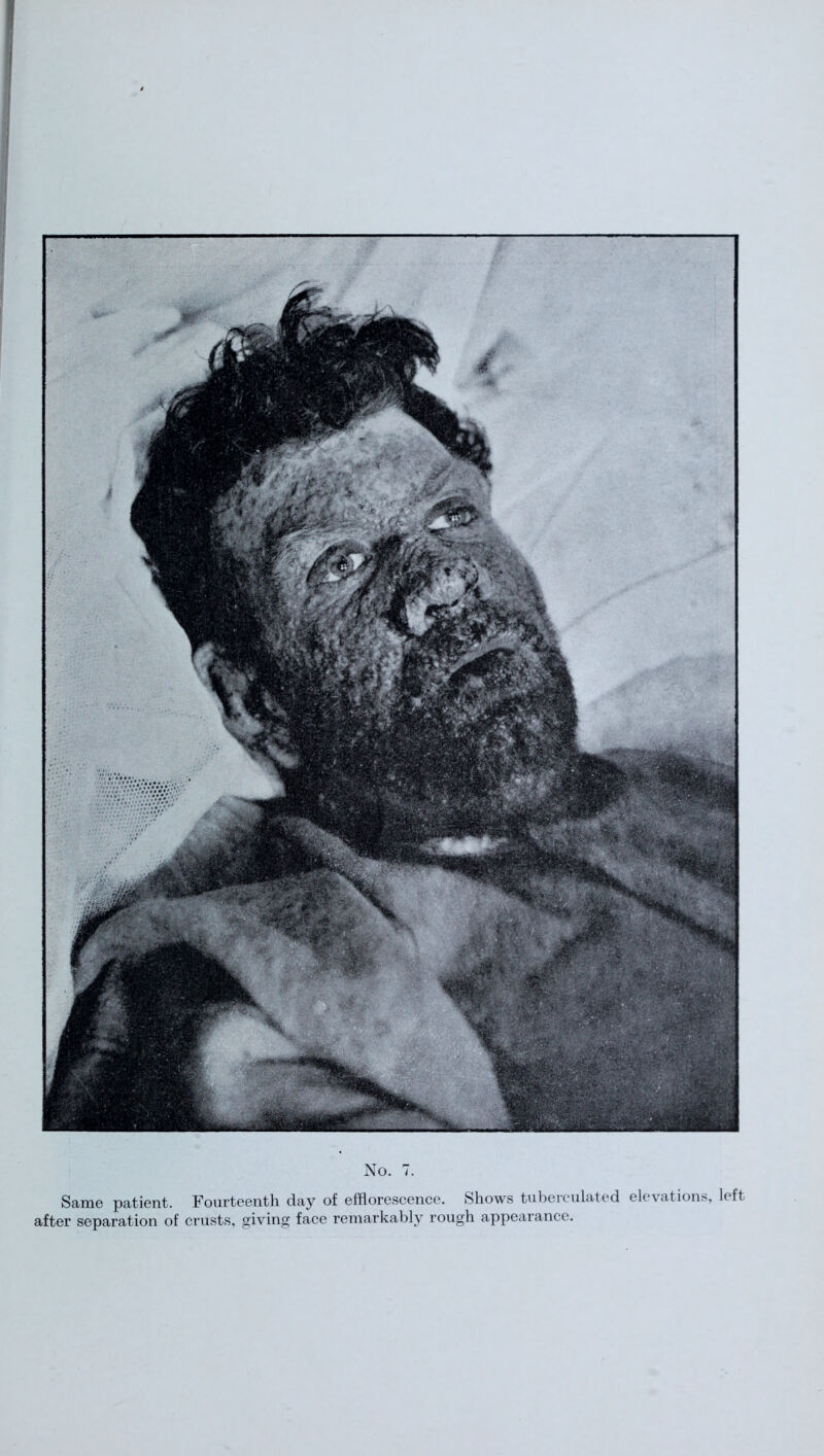 Same patient. Fourteenth day of efflorescence. Shows tuberculated elevations, left after separation of crusts, giving face remarkably rough appearance.