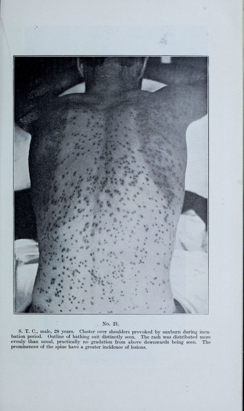 S. T. C., male, 28 years. Cluster over shoulders provoked by sunburn during incu- bation period. Outline of bathing suit distinctly seen. The rash was distributed more evenly than usual, practically no gradation from above downwards being seen. The prominences of the spine have a greater incidence of lesions.