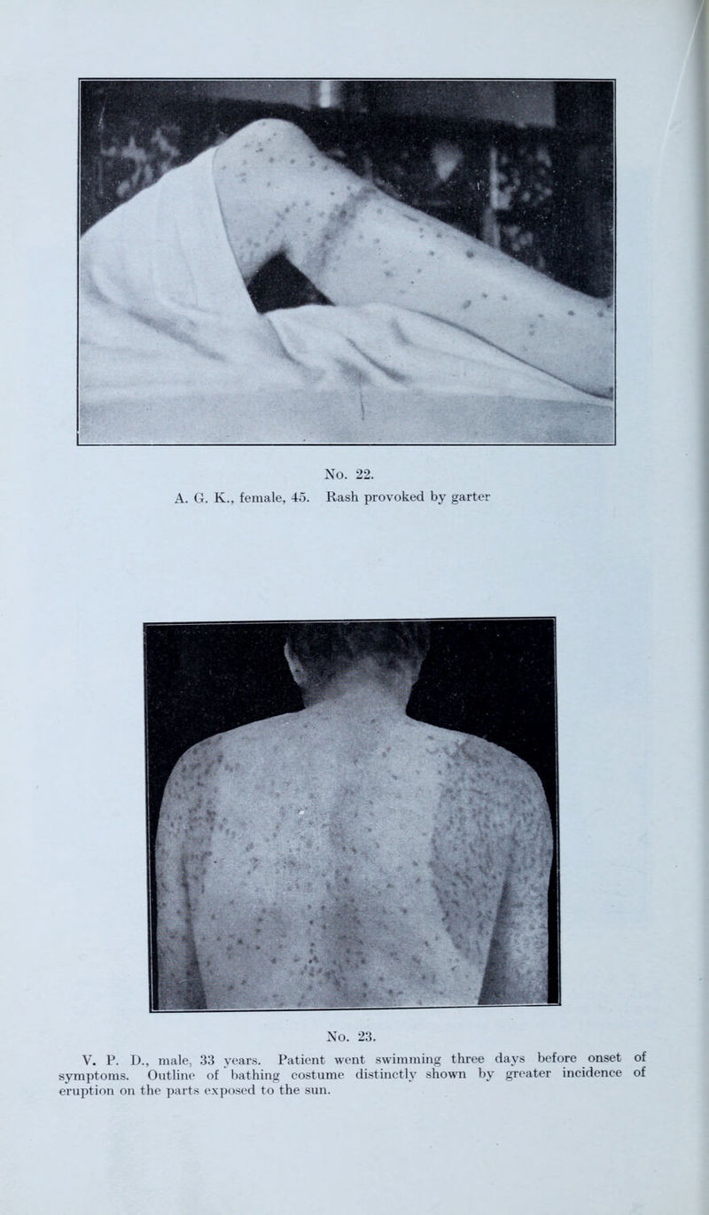 A. G. K., female, 45. Rash provoked by garter No. 23. V. P. D., male. 33 years. Patient went swimming three days before onset of symptoms. Outline of bathing costume distinctly shown by greater incidence of eruption on the parts exposed to the sun.