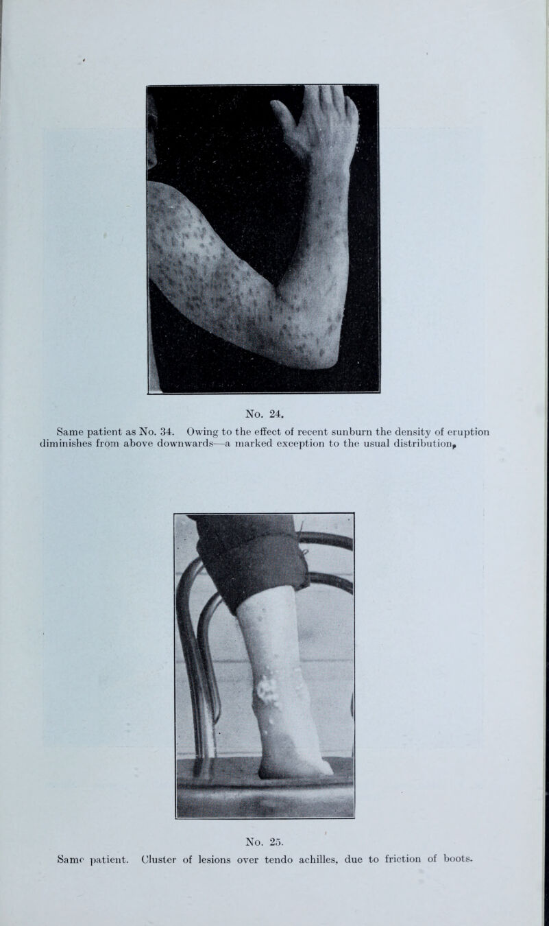 I No. 24. Same patient as No. 34. Owing to the effect of recent sunburn the density of eruption diminishes from above downwards—a marked exception to the usual distribution^ No. 25. Same patient. Cluster of lesions over tendo achilles, due to friction of boots.